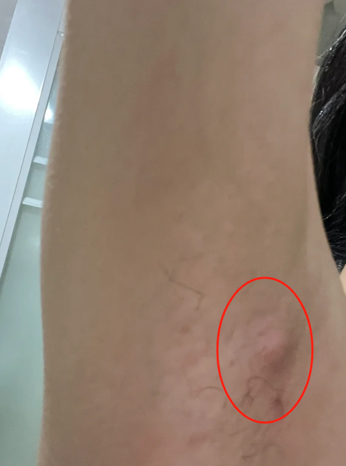 腋下长疙瘩怎么治疗?