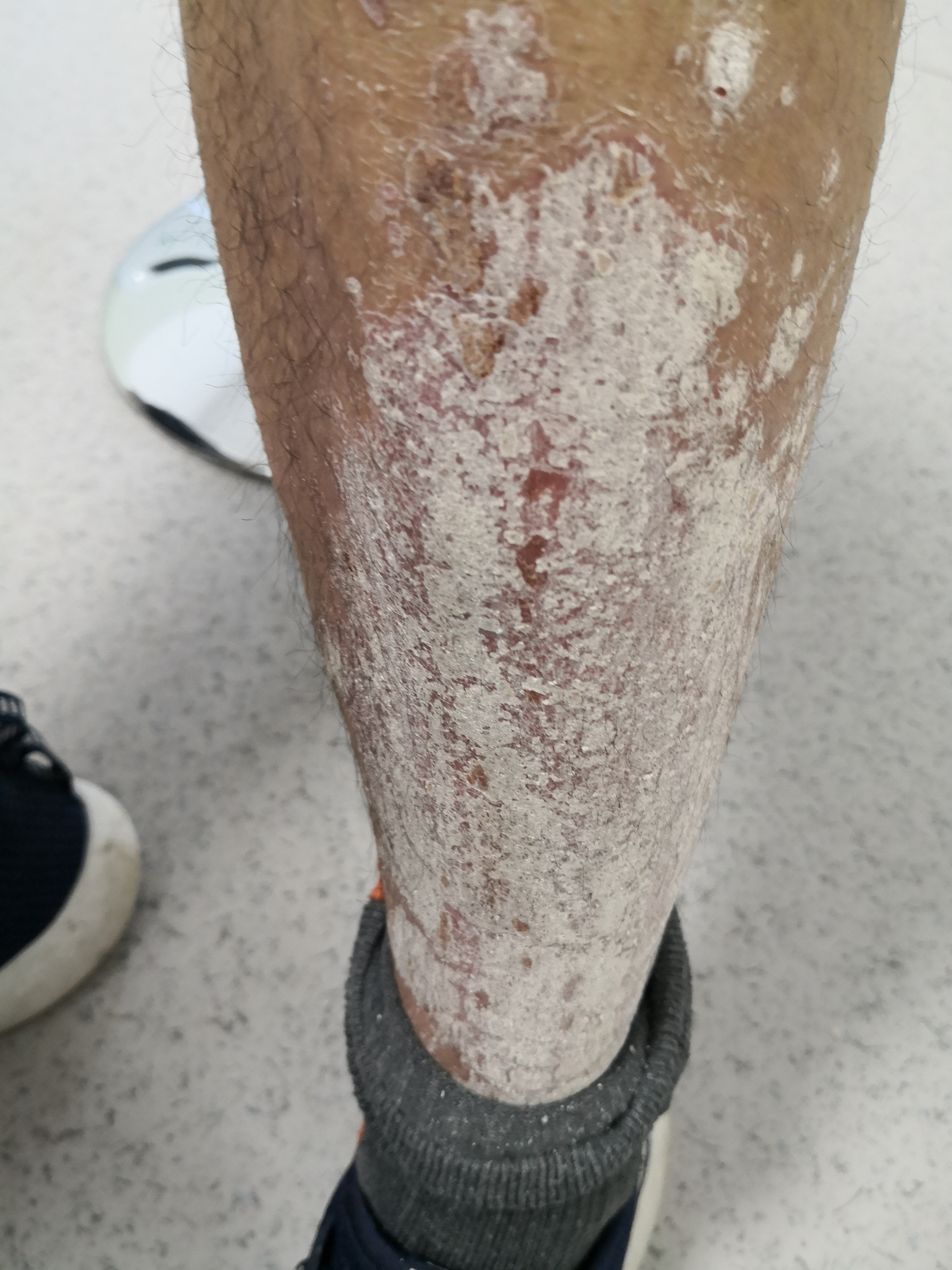 银屑病患者的双小腿伸侧症状