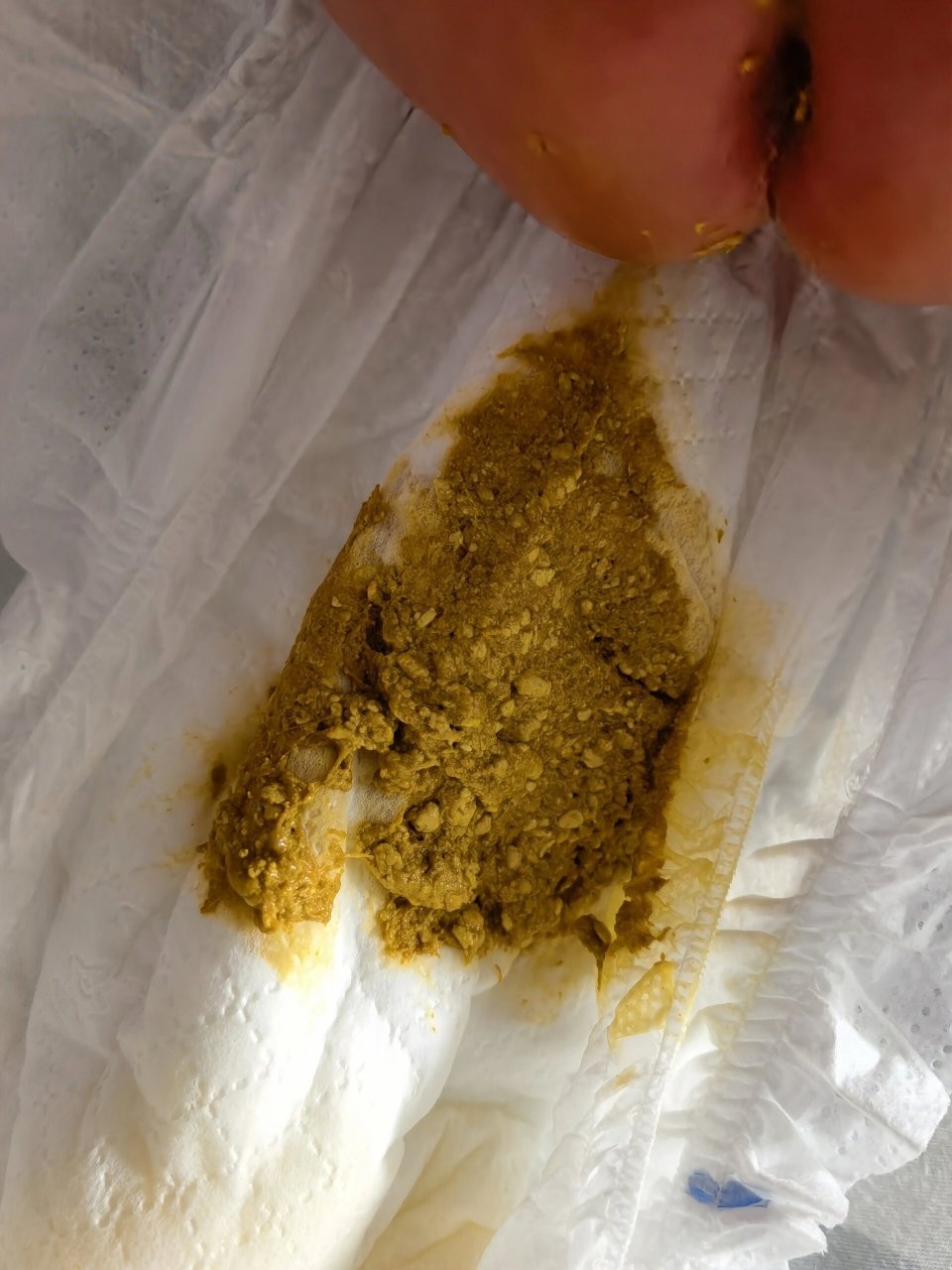 11出生的宝宝,现在喝的皇家美素力,便便金黄,但是奶瓣挺多,需要干预嘛