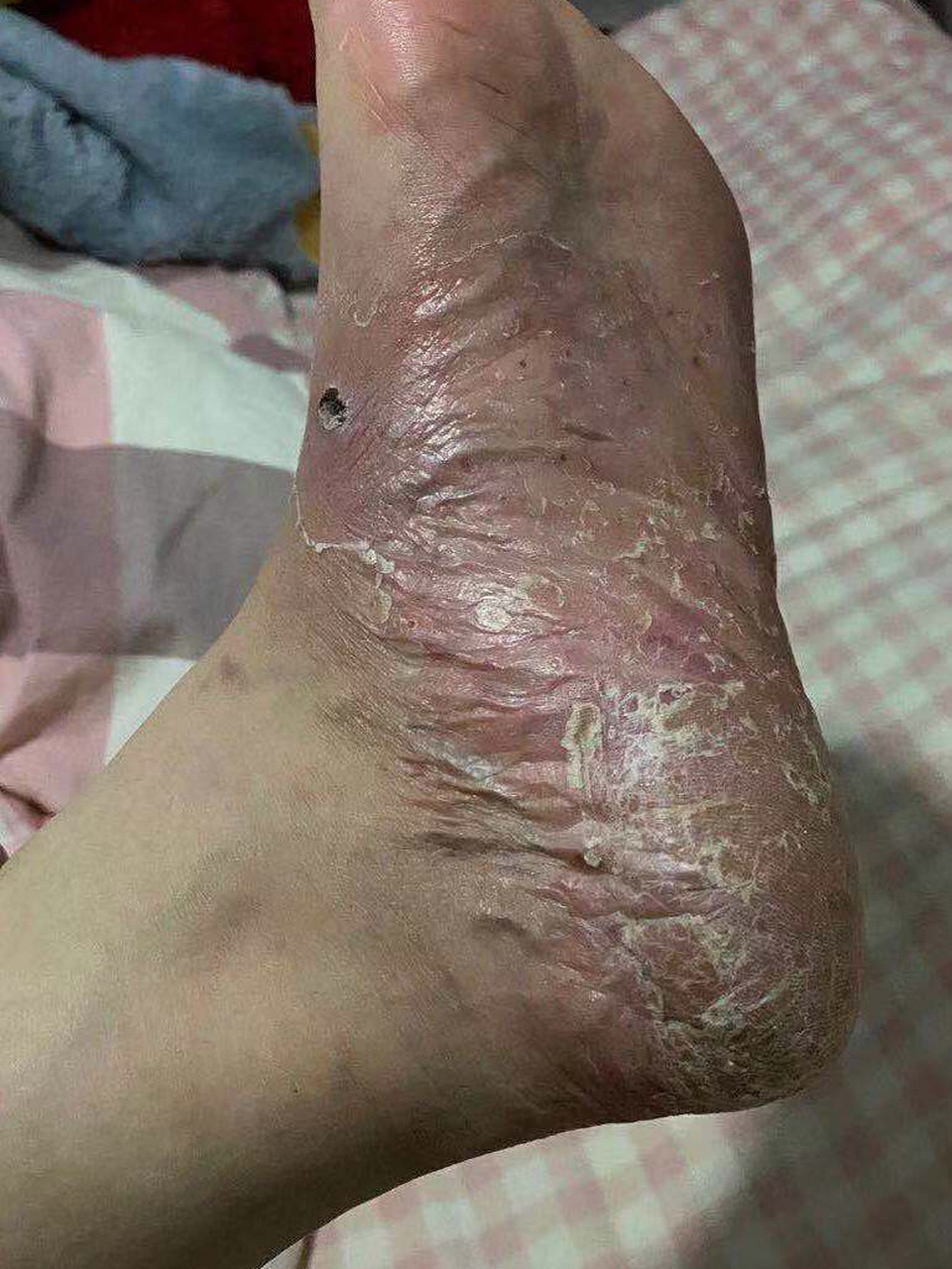 掌跖脓包病～6天的变化