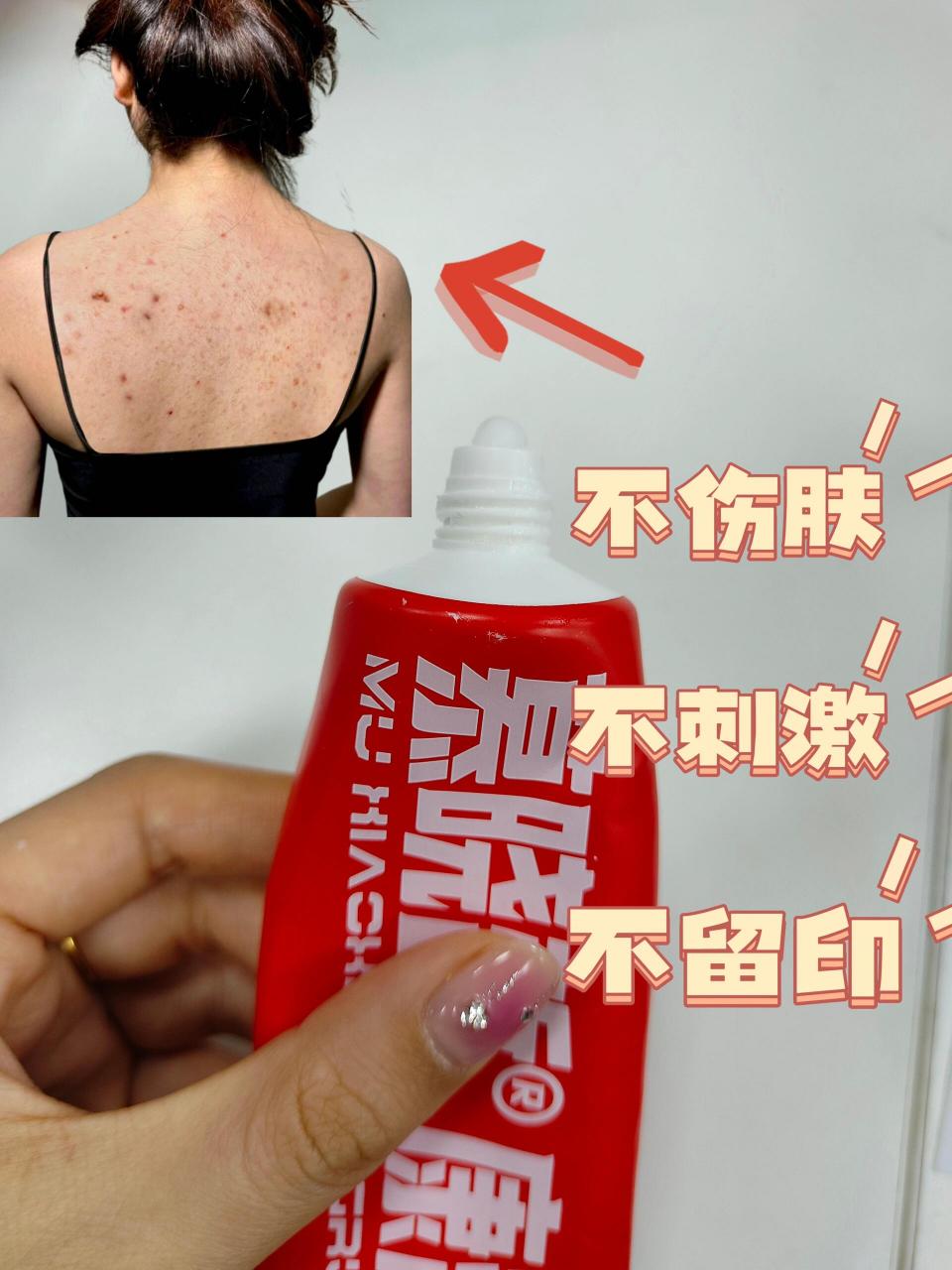 你的痘痘可能是毛囊炎,教你一招轻松解决!