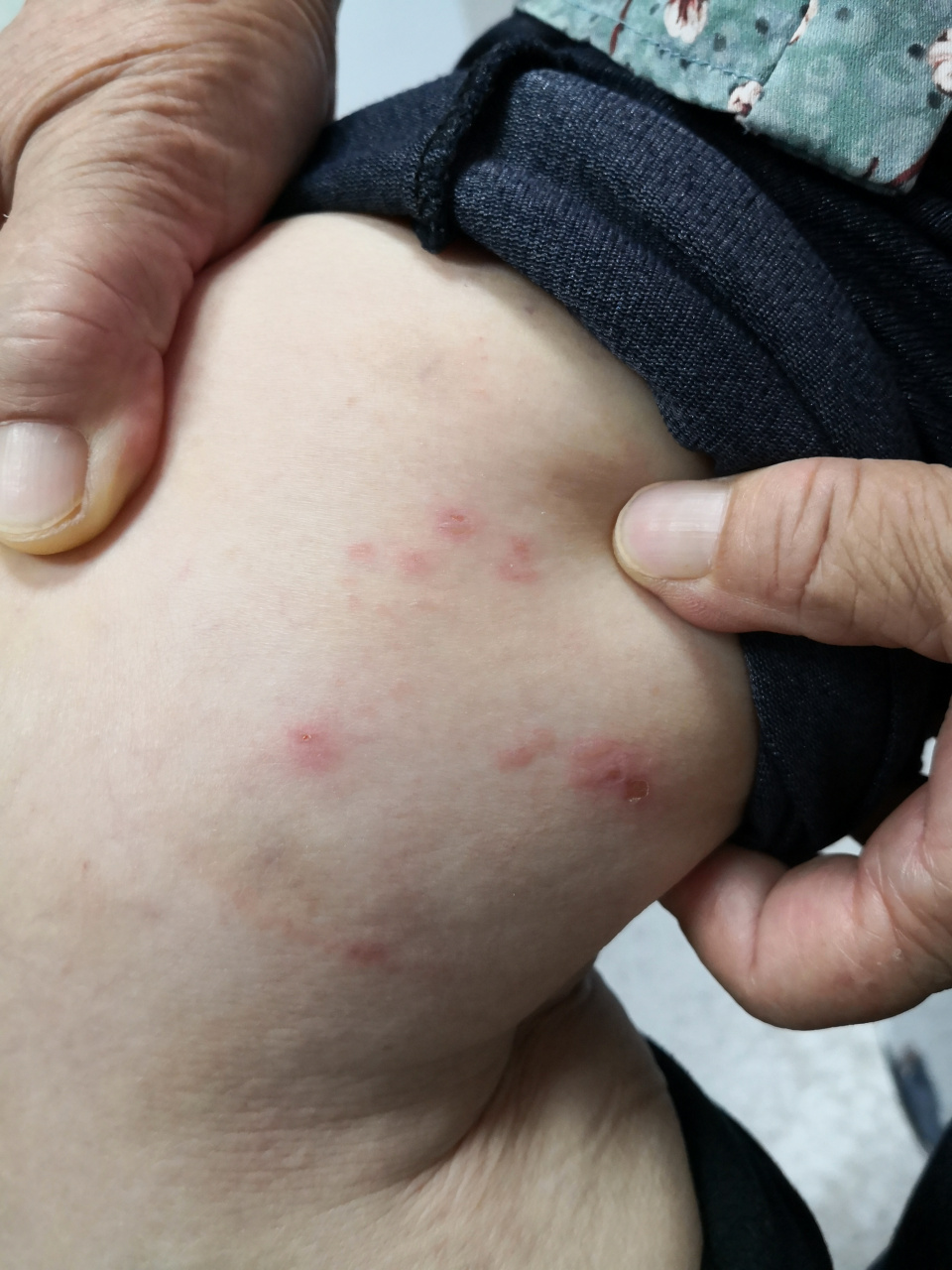 带状疱疹##解决皮肤问题专注皮肤美容