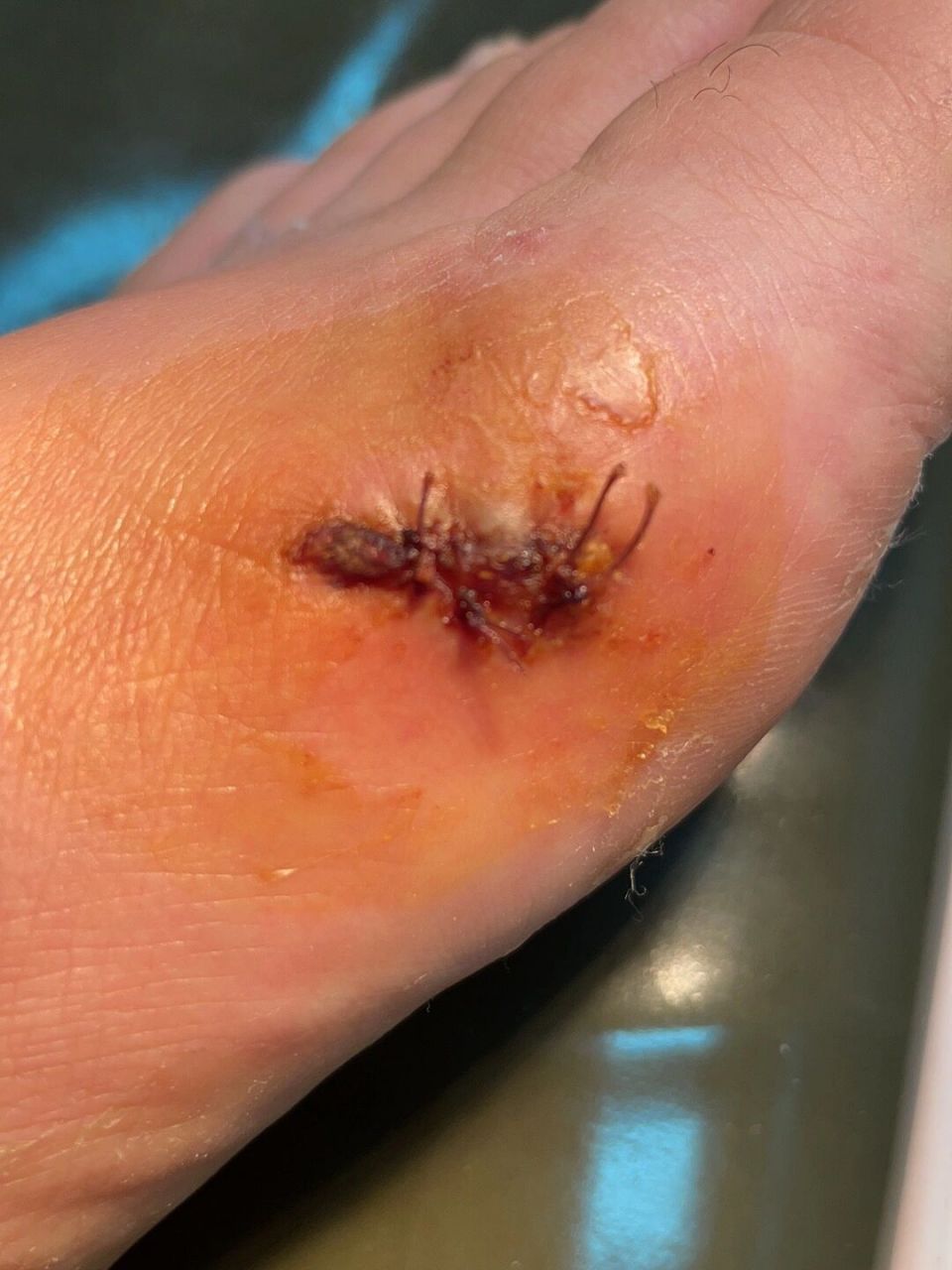 犹豫创伤部位轻些的地方不是美容缝针需要拆线,于是 嗯 我开启了人生