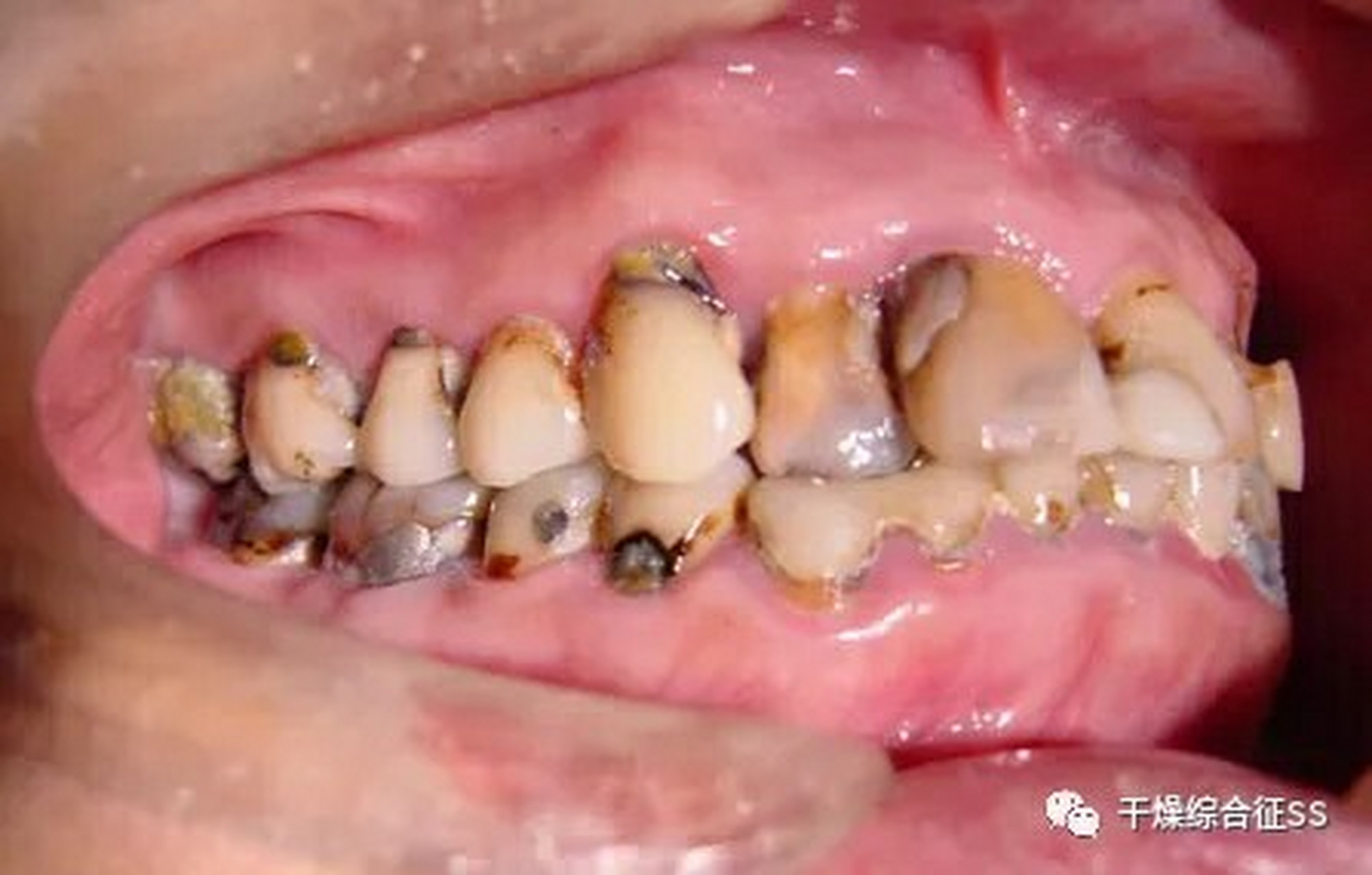 口眼干燥,关节疼痛是干燥综合征主要症状,由于外分泌腺体病变导致唾液