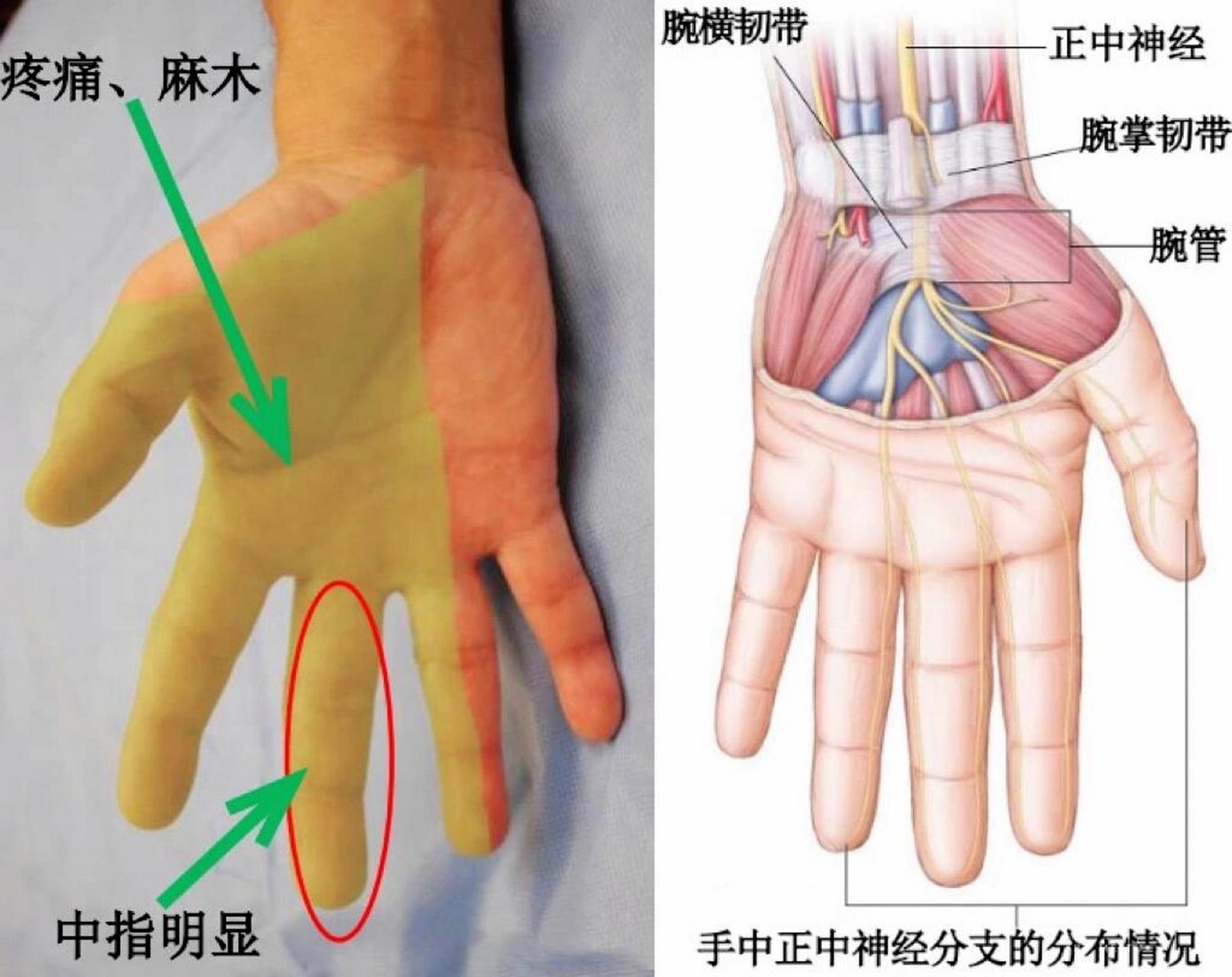 手麻可能是腕管综合征 正中神经在腕管内受压迫引起手指麻木,疼痛