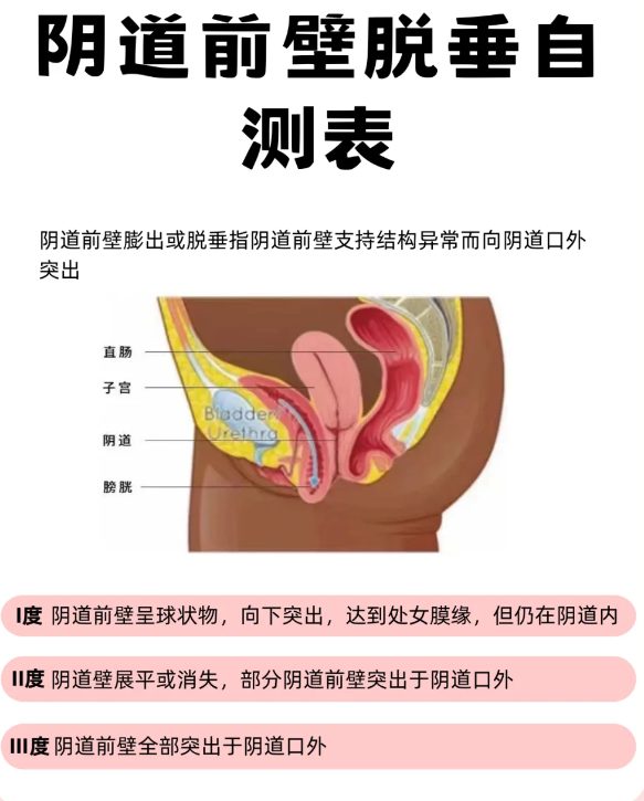 主要原因是盆底肌松弛导致阴道前壁膨出