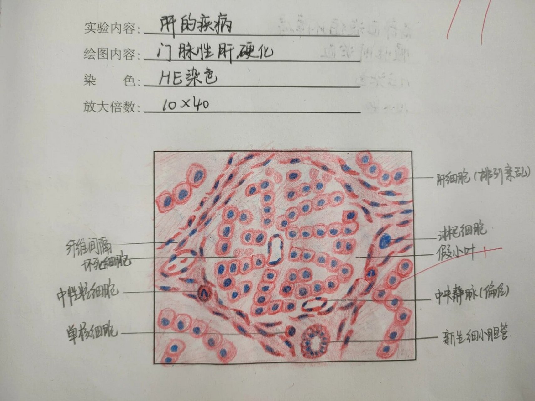 慢性胃溃疡手绘图图片