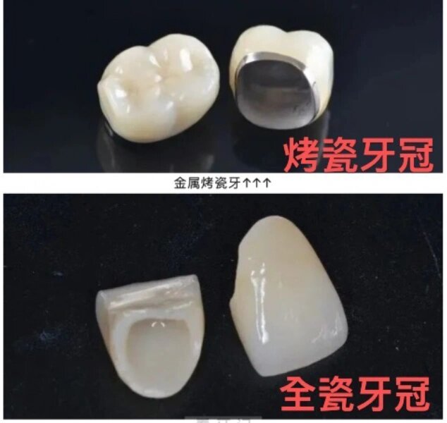 烤瓷牙的寿命一般多久(图1)
