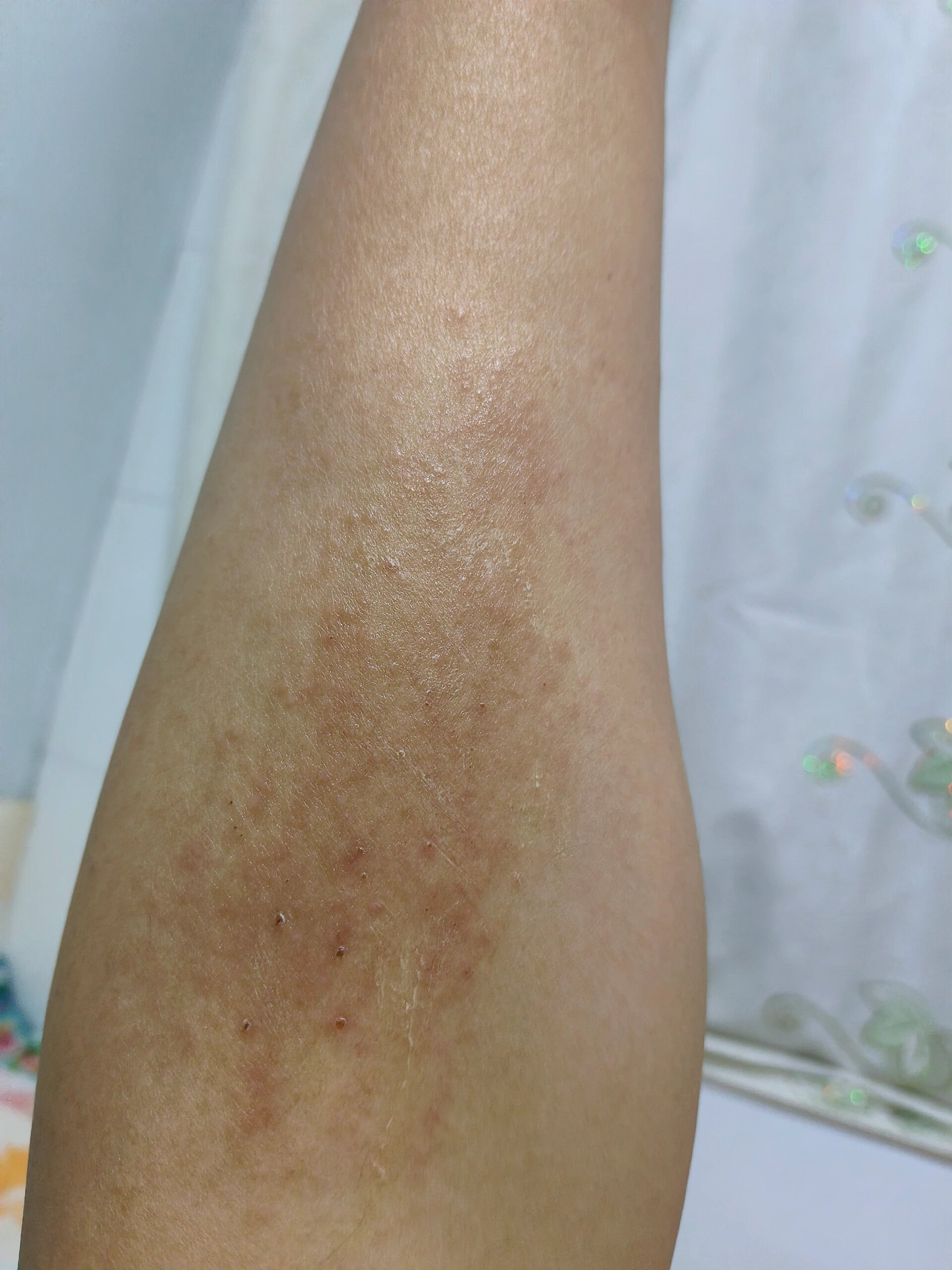 小腿起了一片疙瘩
