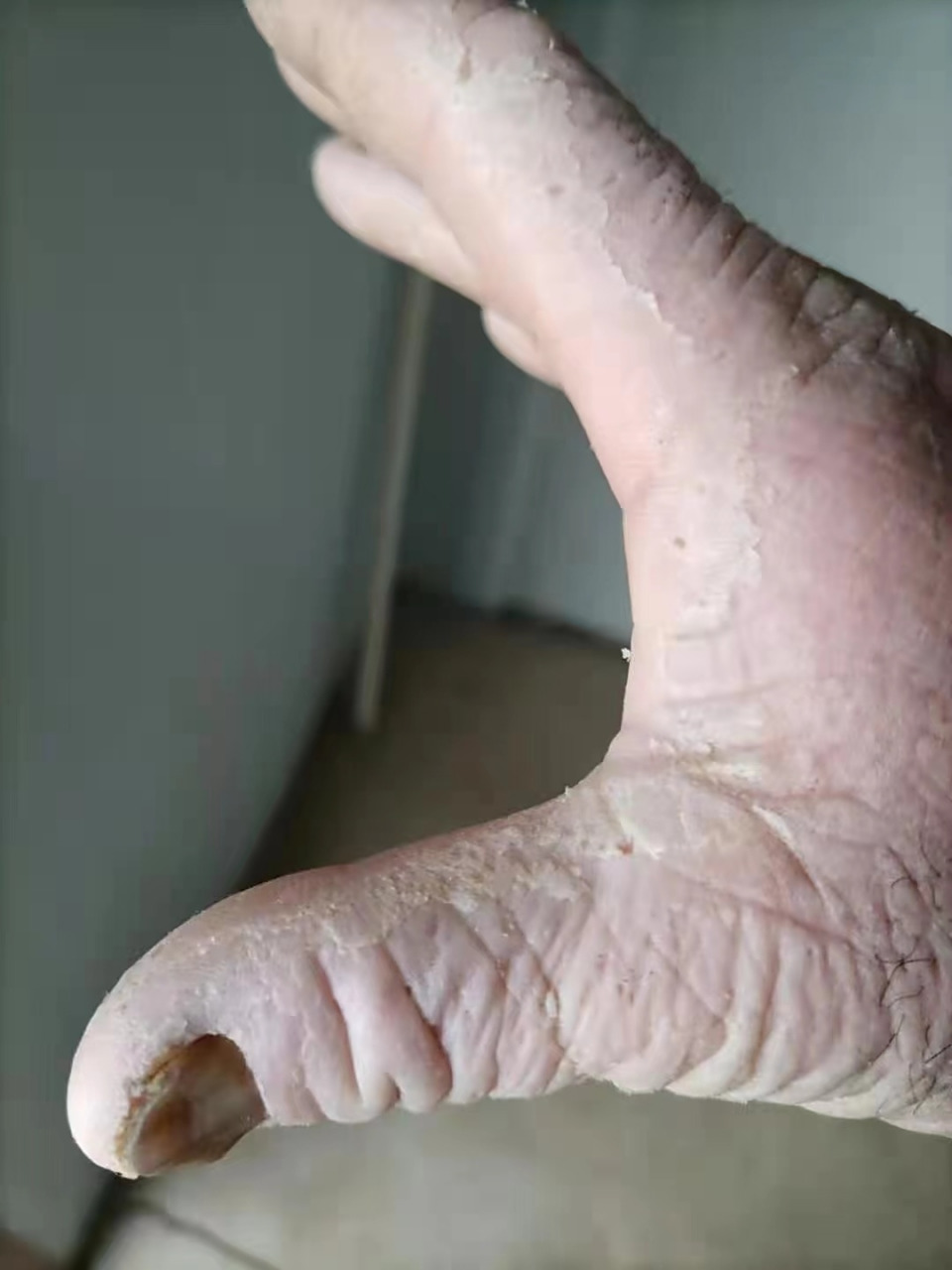 水源性肢端角化症治疗三天的效果 1,2图是治疗前接触水的情况 3图是