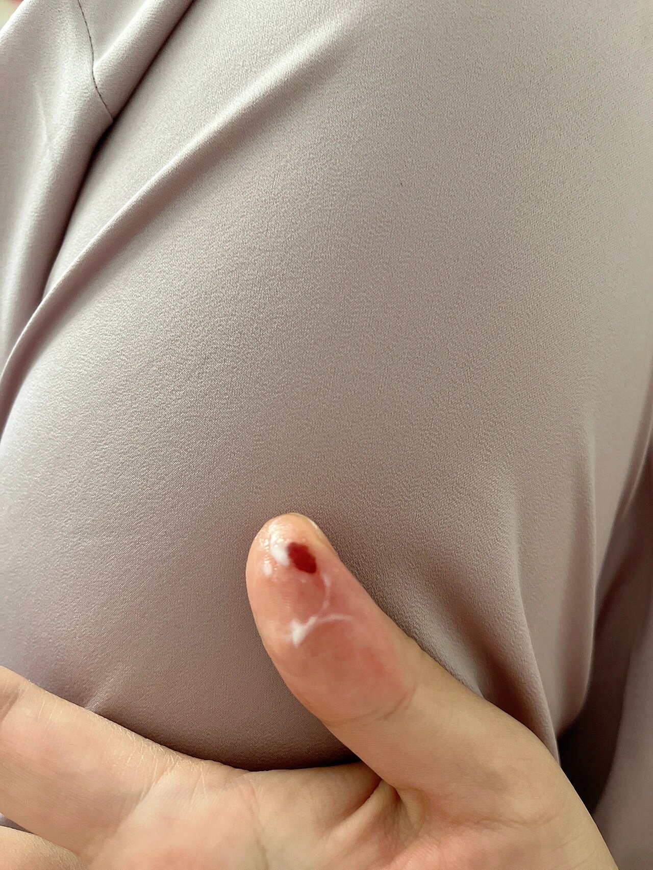 脓性指头炎,中医叫蛇头疔快两个星期了 我搜发现好多姐妹都是因为拔