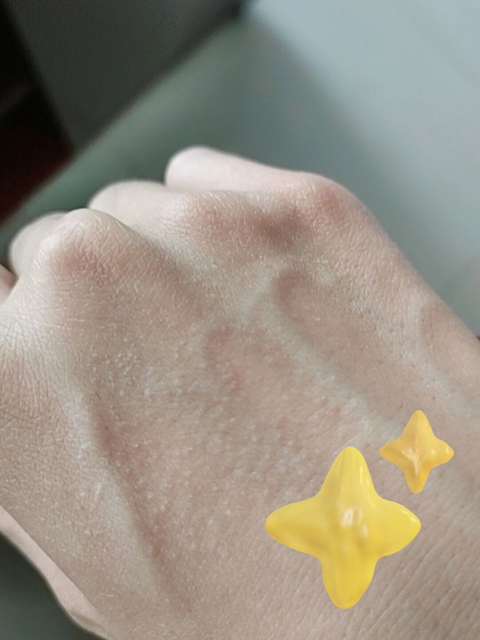 求助92 为什么手背上忽然像过敏一样起了很多点点