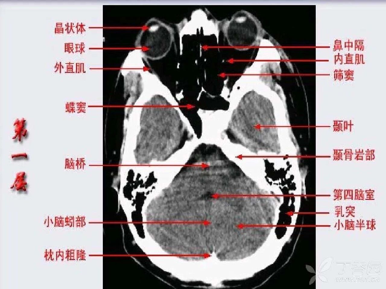 小脑上池解剖图图片