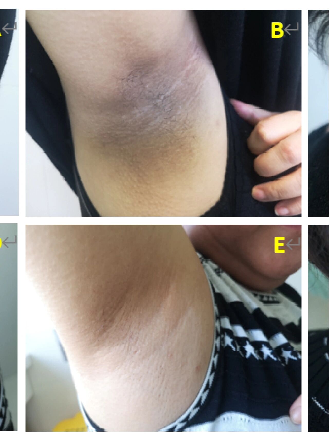 好在这位除了尿酸有点高,没有其他特别疾病,引起黑棘皮病的元凶是