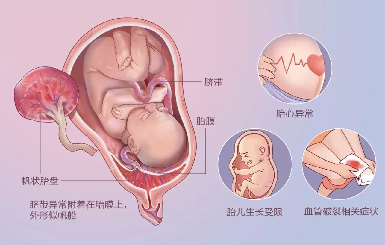 73   小知识 帆状胎盘指脐带附着在胎膜上