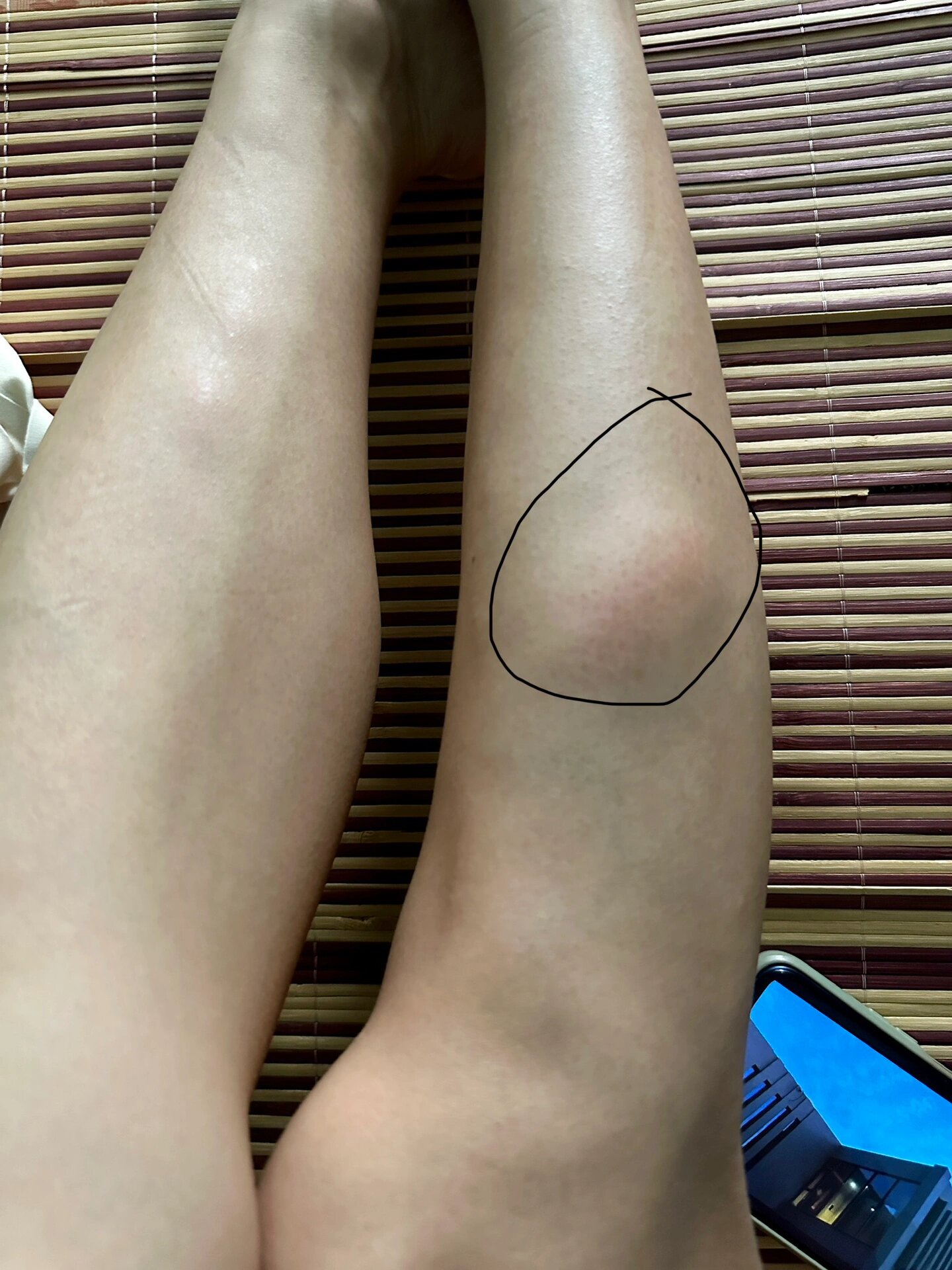 有哪位大神知道小腿突然肿了一块是怎么回事吗?