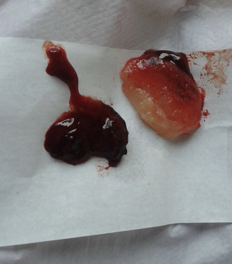 图二网上找的慎点 相信很多第一次怀孕但是自然