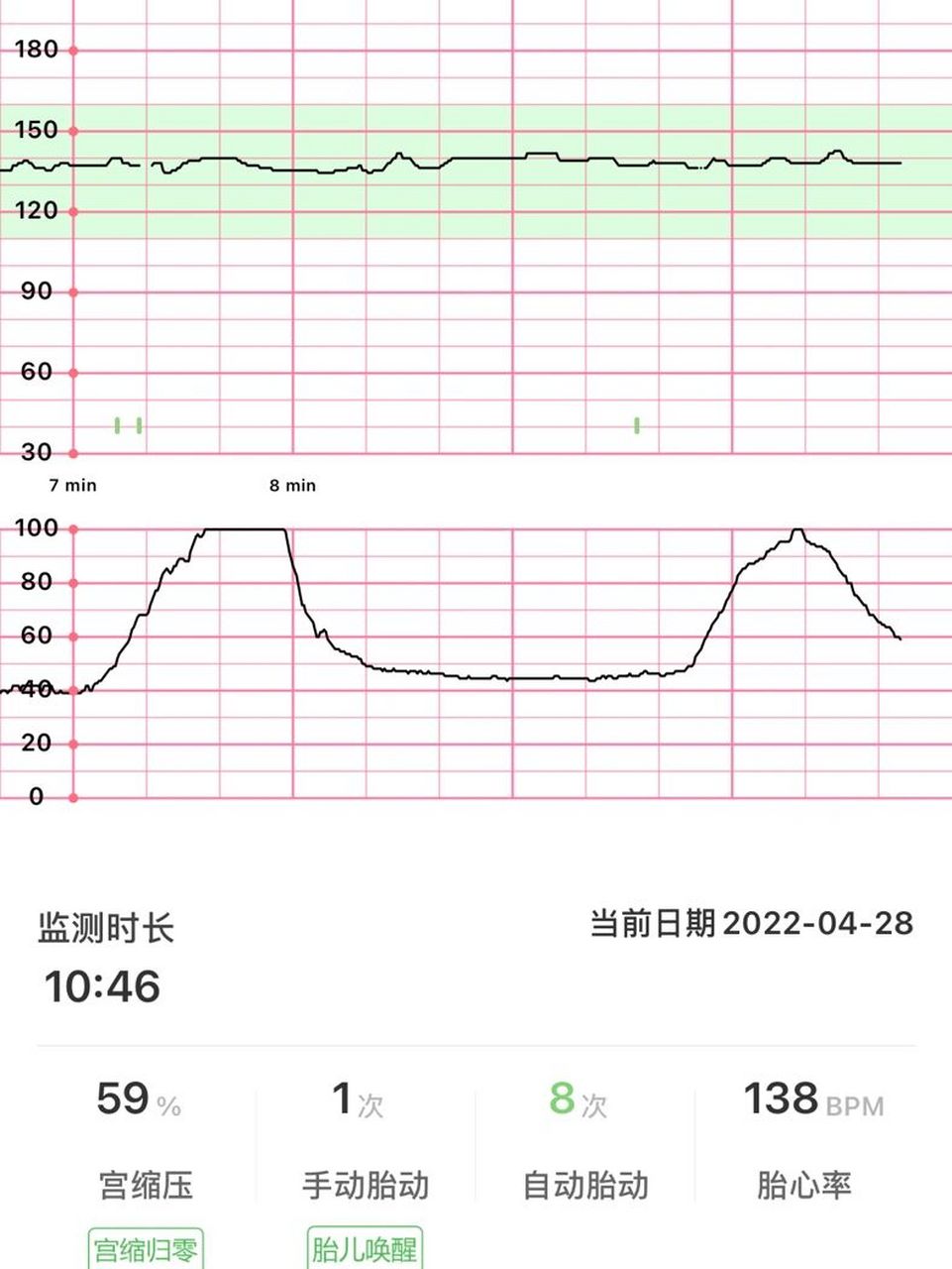 正常的胎心监护曲线图图片