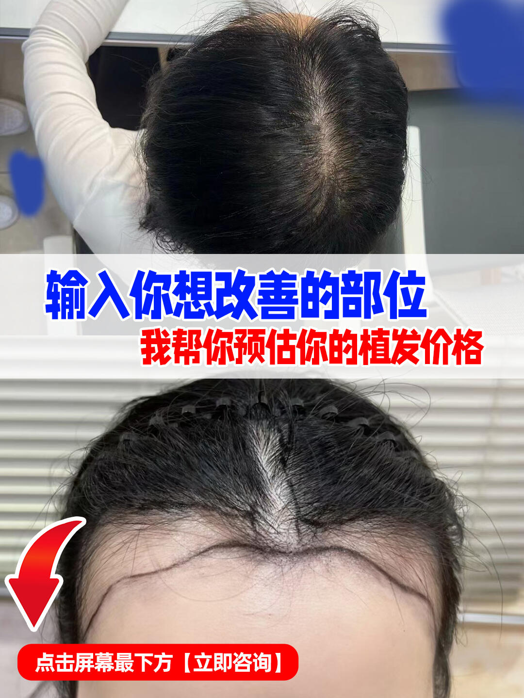 多少钱可以植发(现在植发需要多少钱一根)