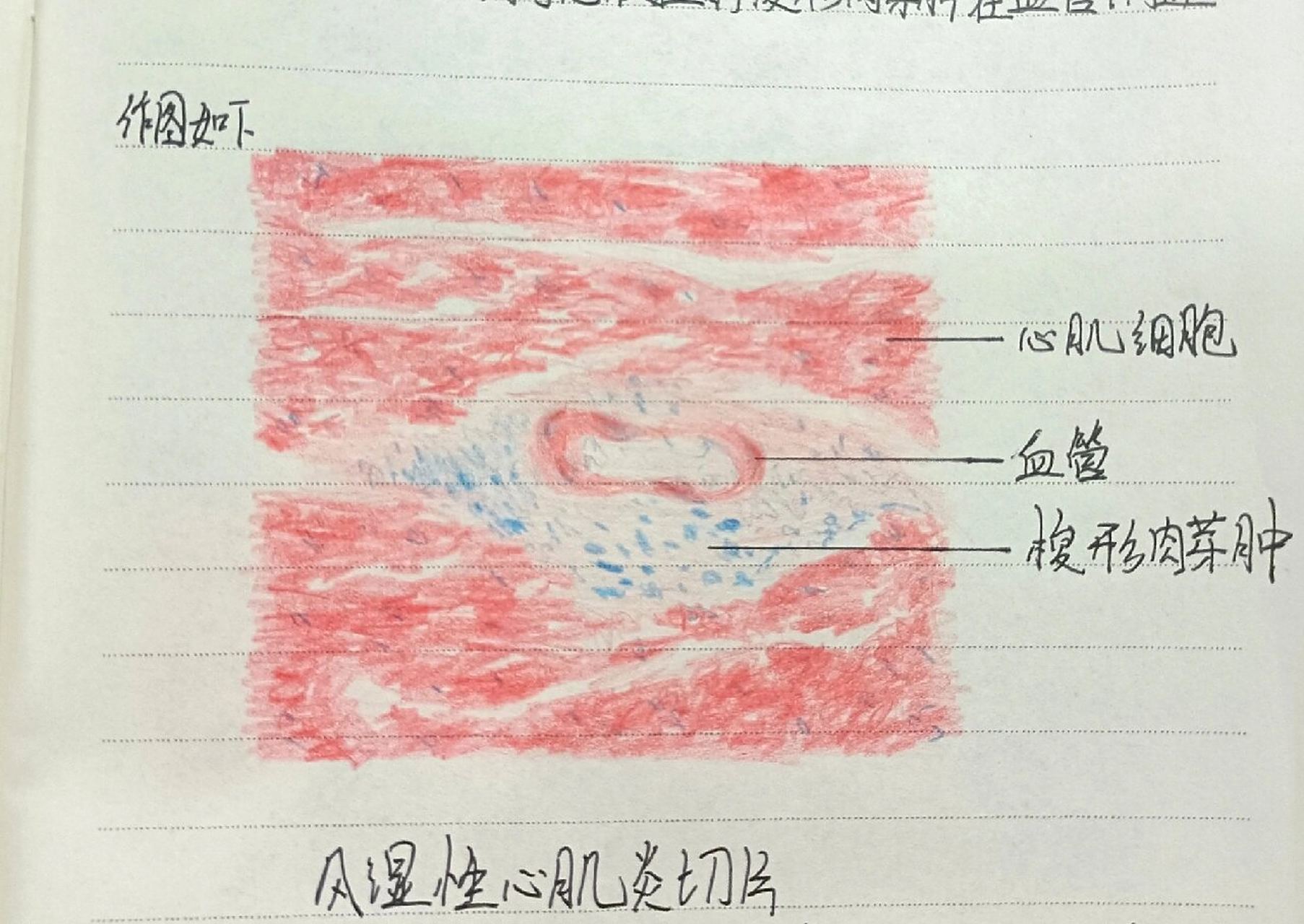 风湿性心肌炎切片观察(低倍镜和高倍镜)