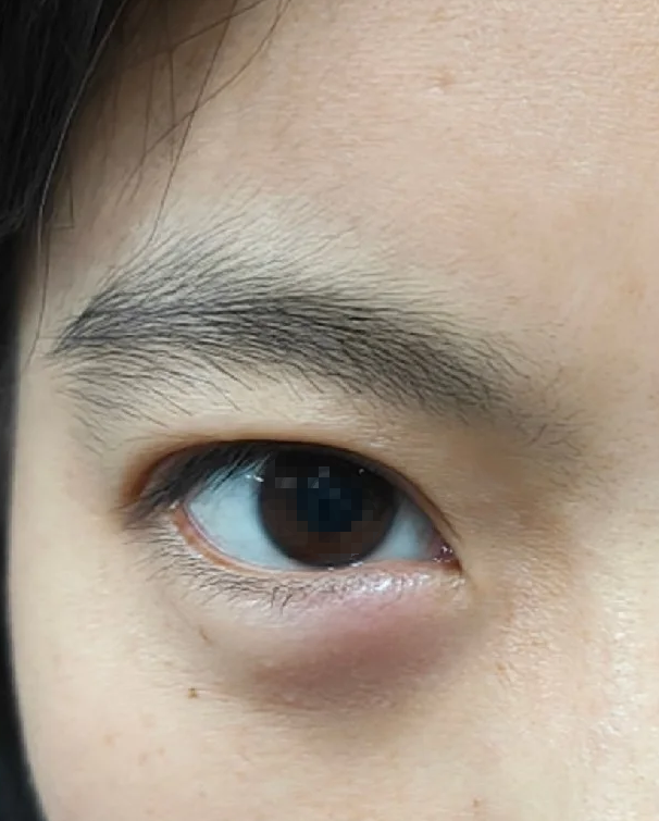 下眼睑突然肿得像眼袋,常见原因有睡前喝水太多,睑腺炎或霰粒肿