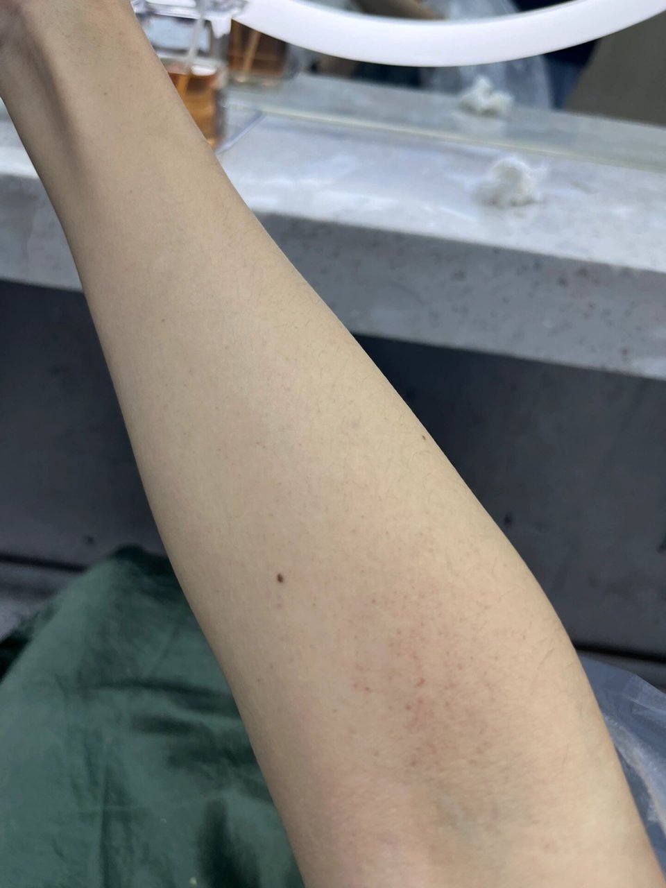 只有右手臂上有,左手没有 有可能是过敏性紫癜吗补充一下 昨天男朋友