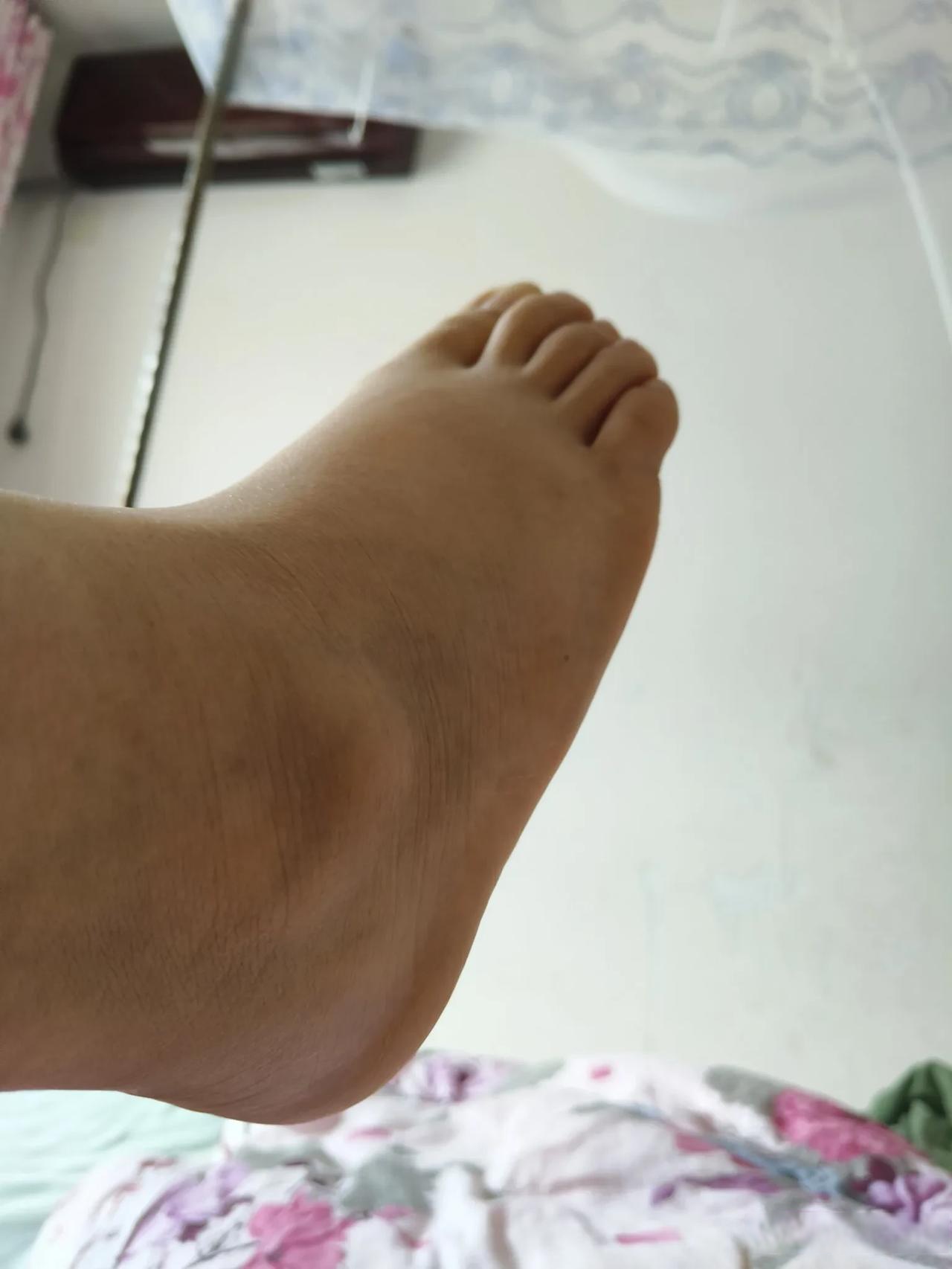 崴到脚11天了,早上起床基本消肿了,也不疼了,我就尝试着走了一下路