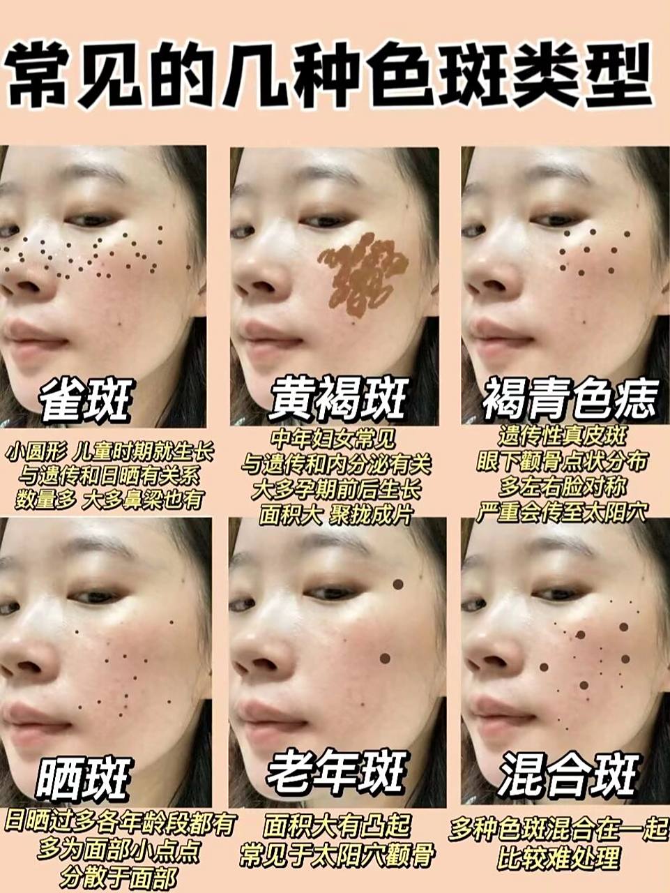黄褐斑,晒斑,雀斑…你的是什么斑?