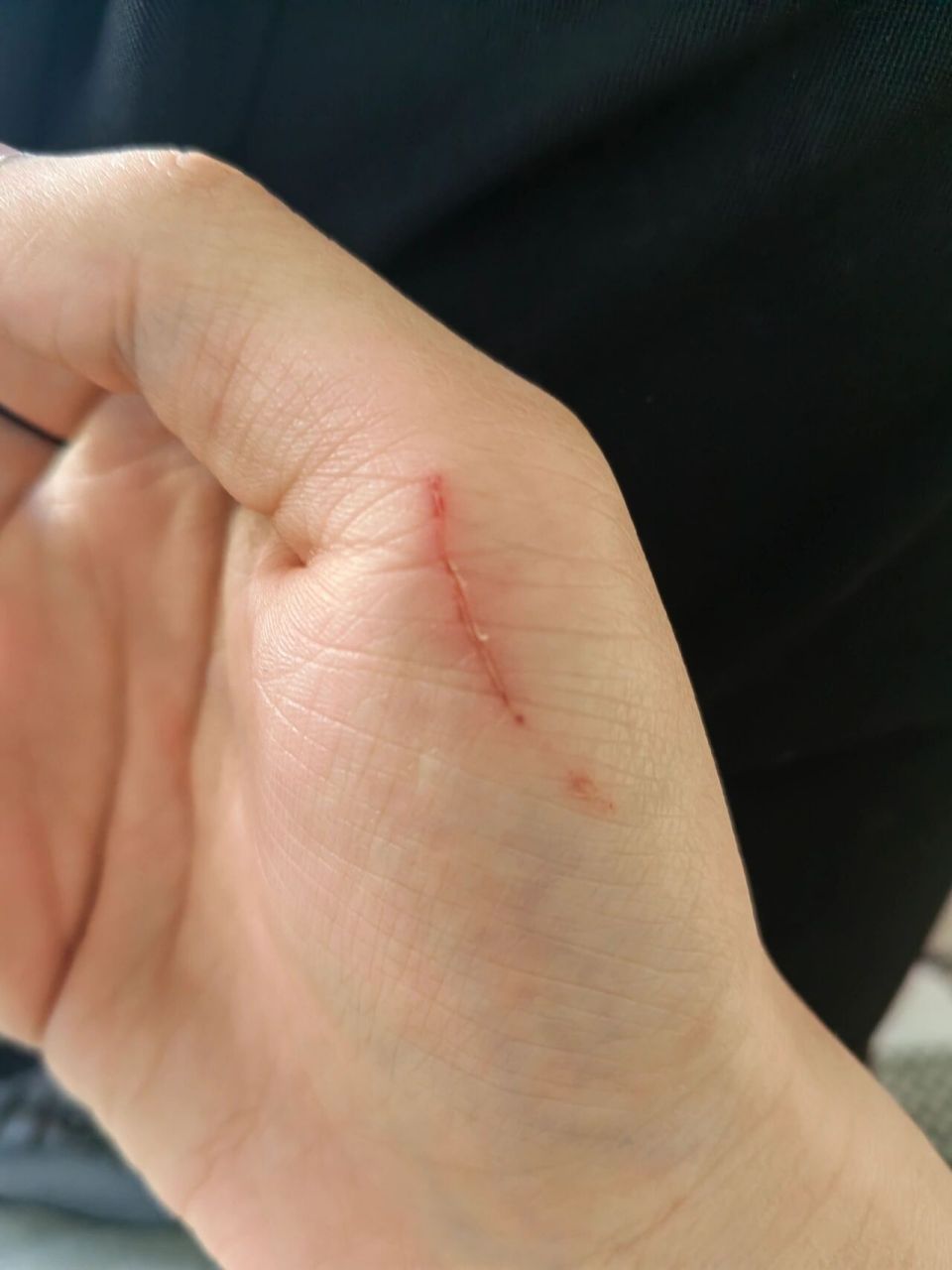 被小狗牙齿划伤了 想问一下姐妹们被家里小狗的尖牙不小心划伤了,必须