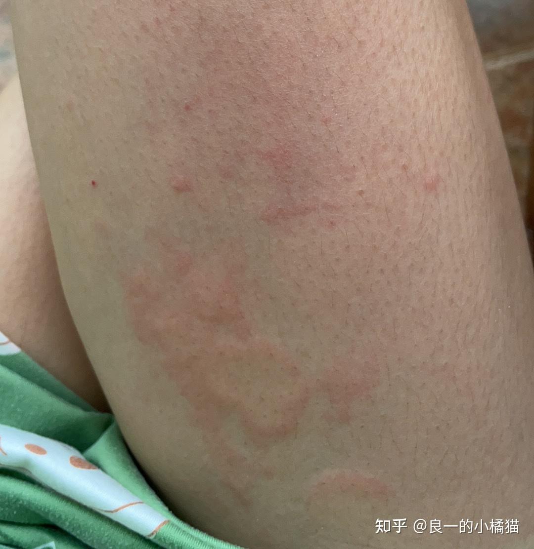 急性荨麻疹治愈之路