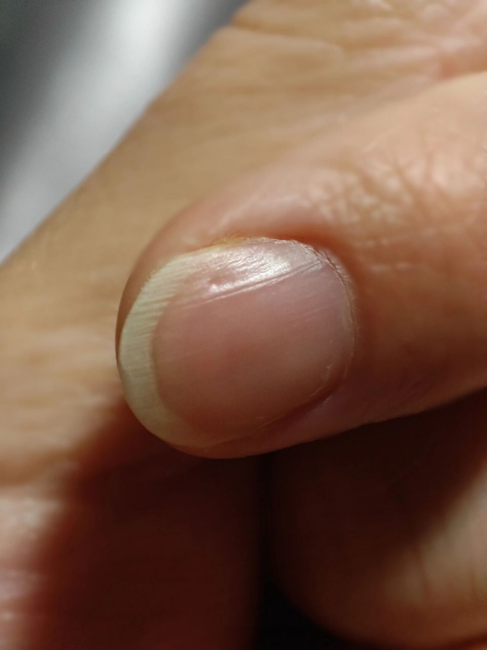 友友们指甲有这种小坑和竖纹是怎么回事求解 友友们指甲有这种小坑和