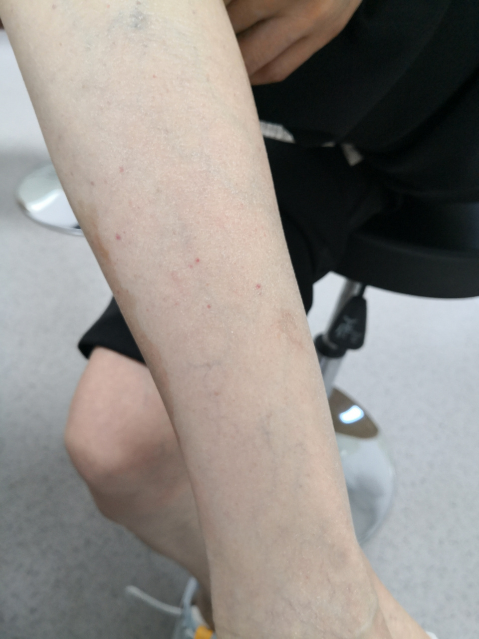 考虑过敏性紫癜症状#解决皮肤问题专注皮肤美容##紫癜