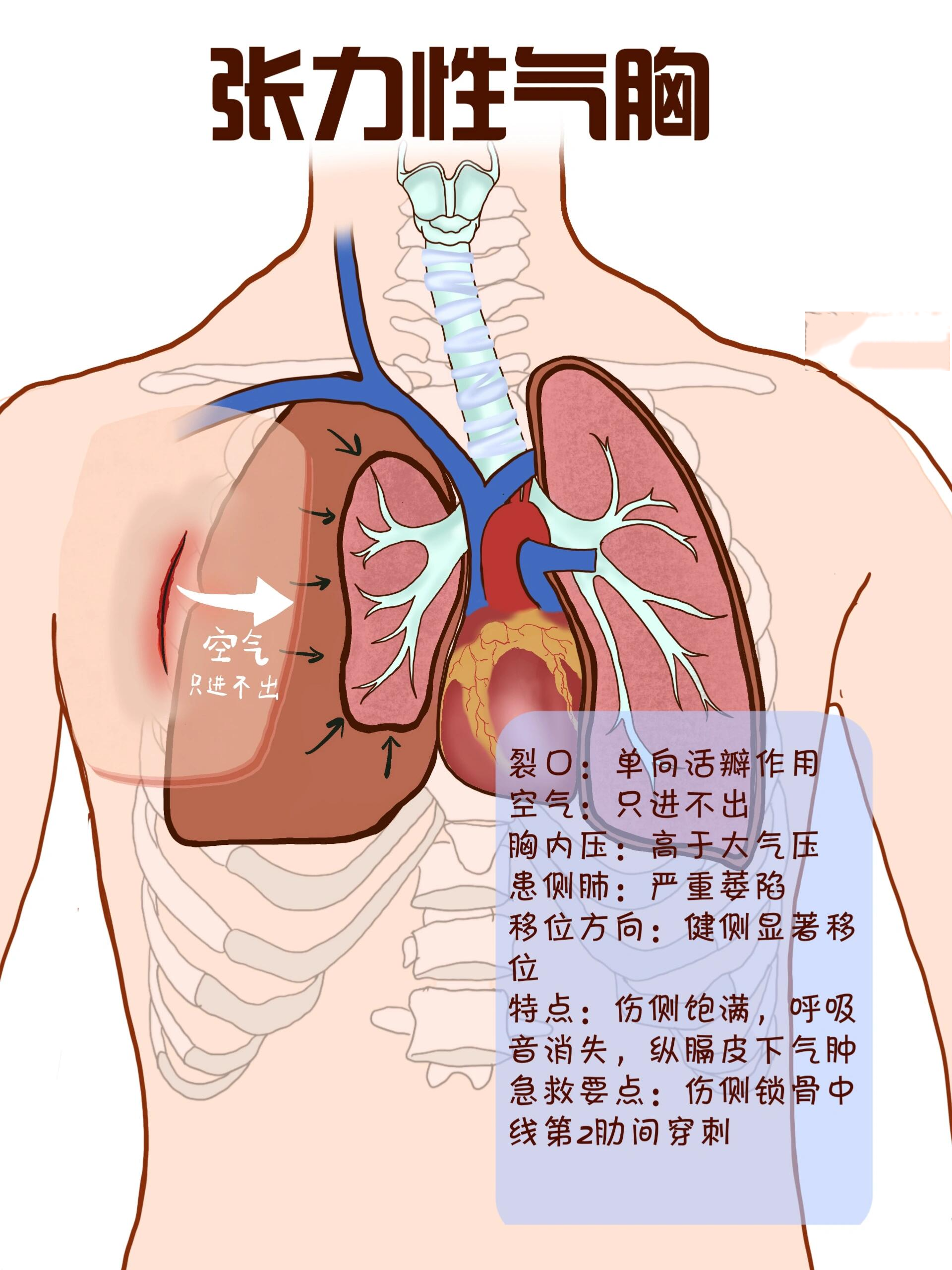 张力性气胸患者图片