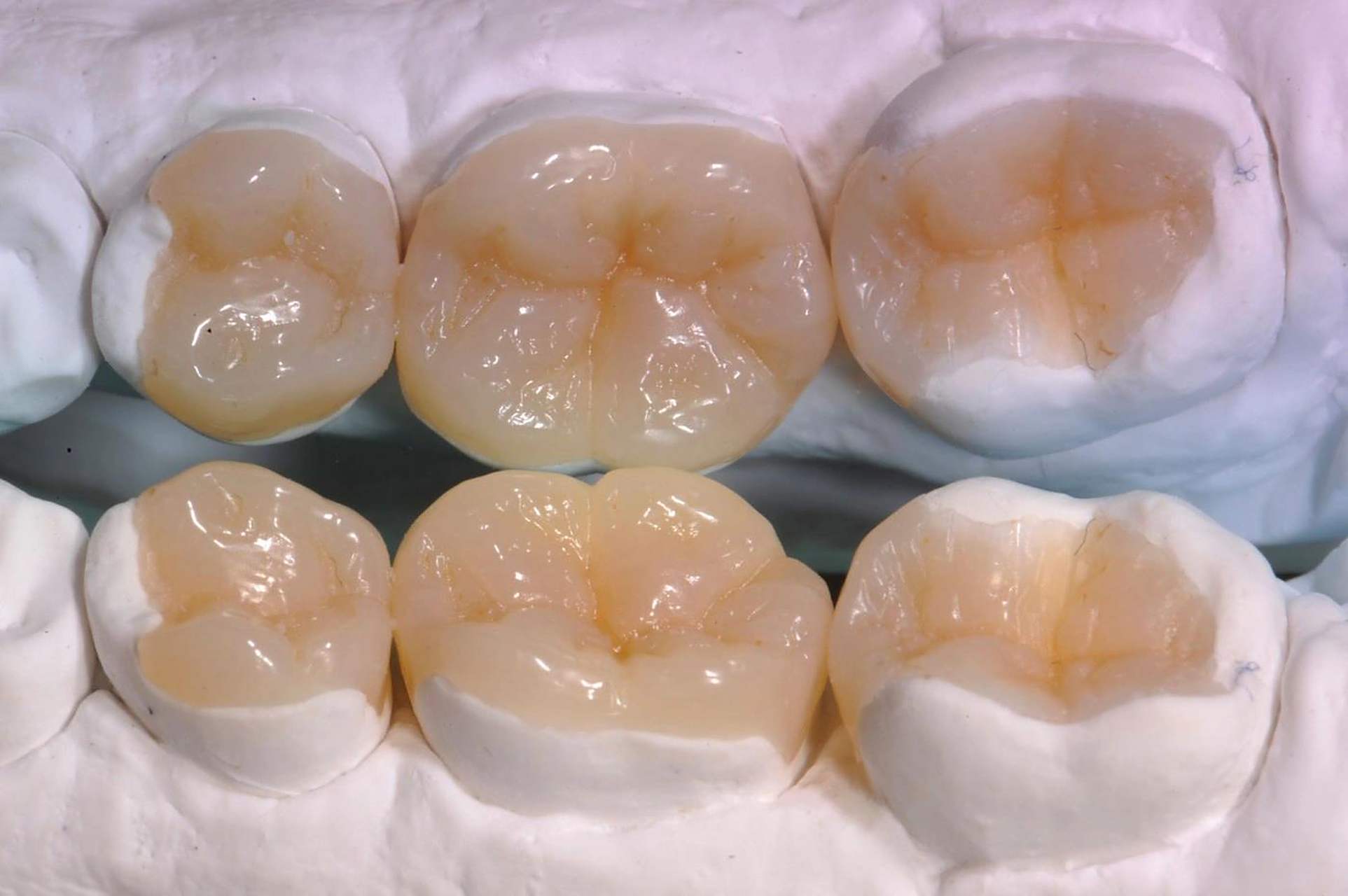 更精准的修复方式—嵌体 传统的补牙是在口内一次性完成,就是把蛀牙的