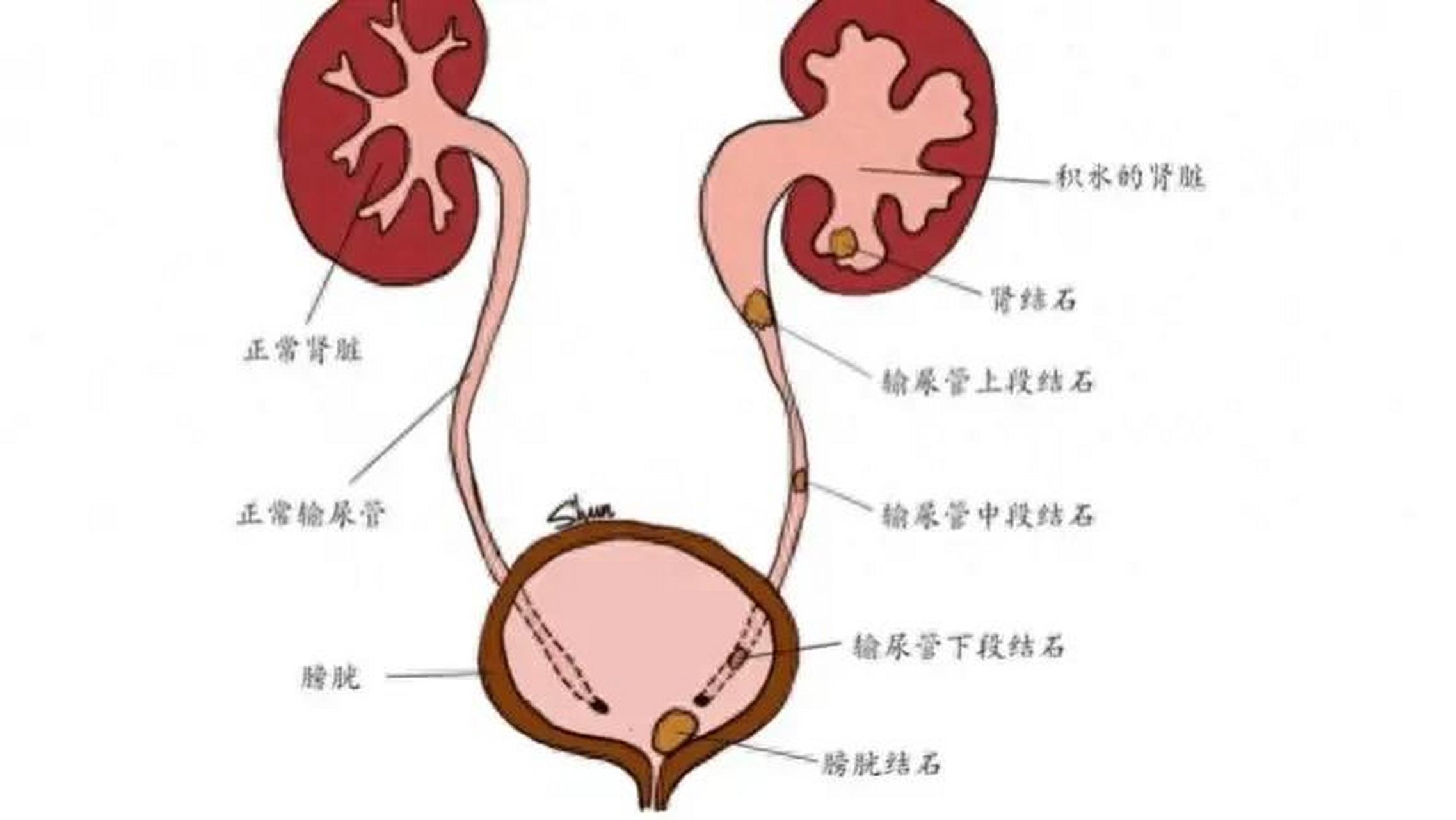 输尿管结石位置图图片