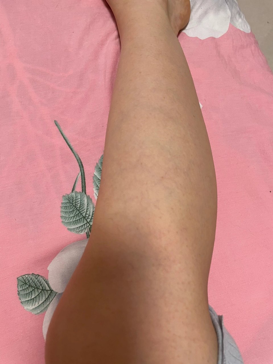 小腿血管明显是怎么回事