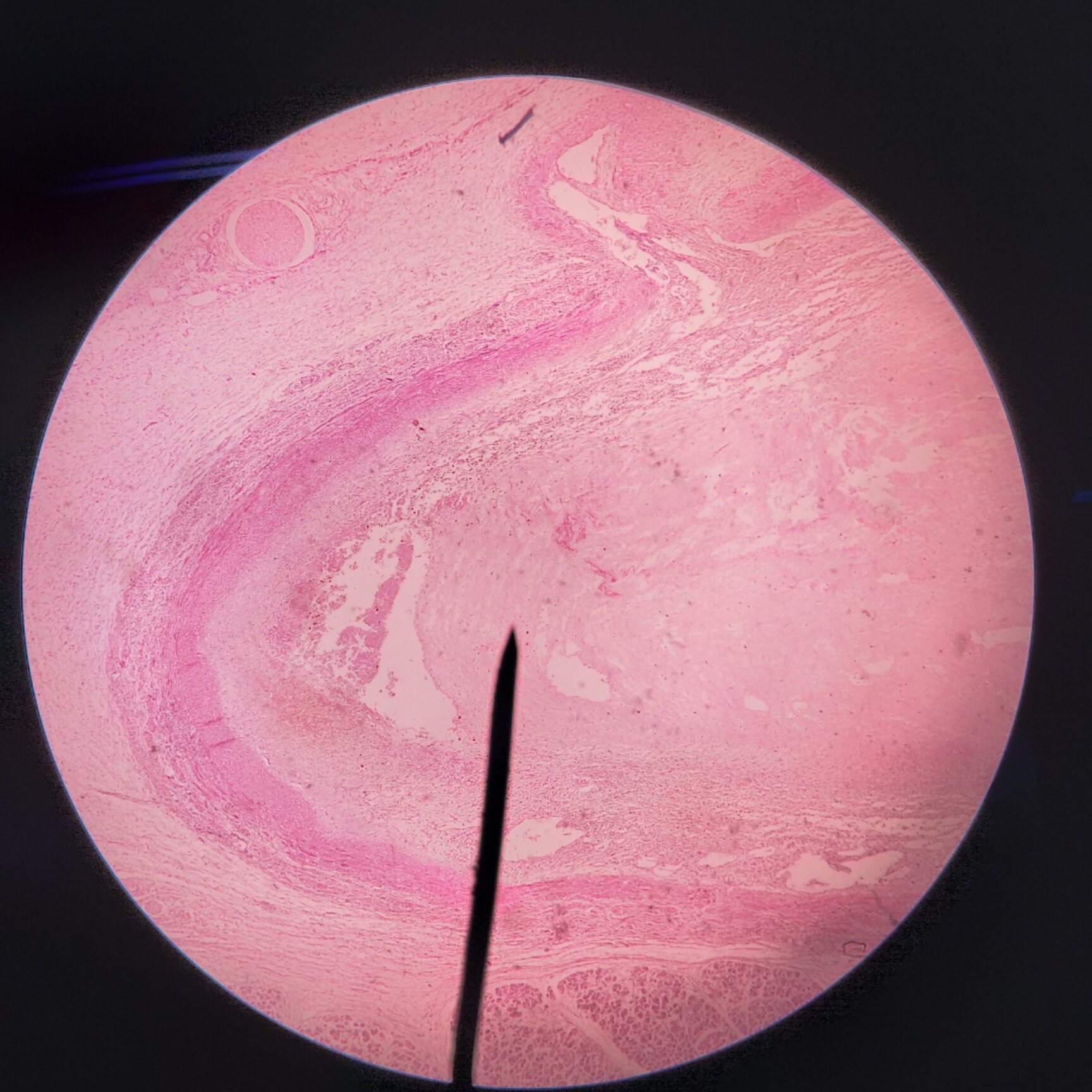 病理学切片-血栓机化与再通,慢性肺淤血 图一到图三是血栓机化与再通