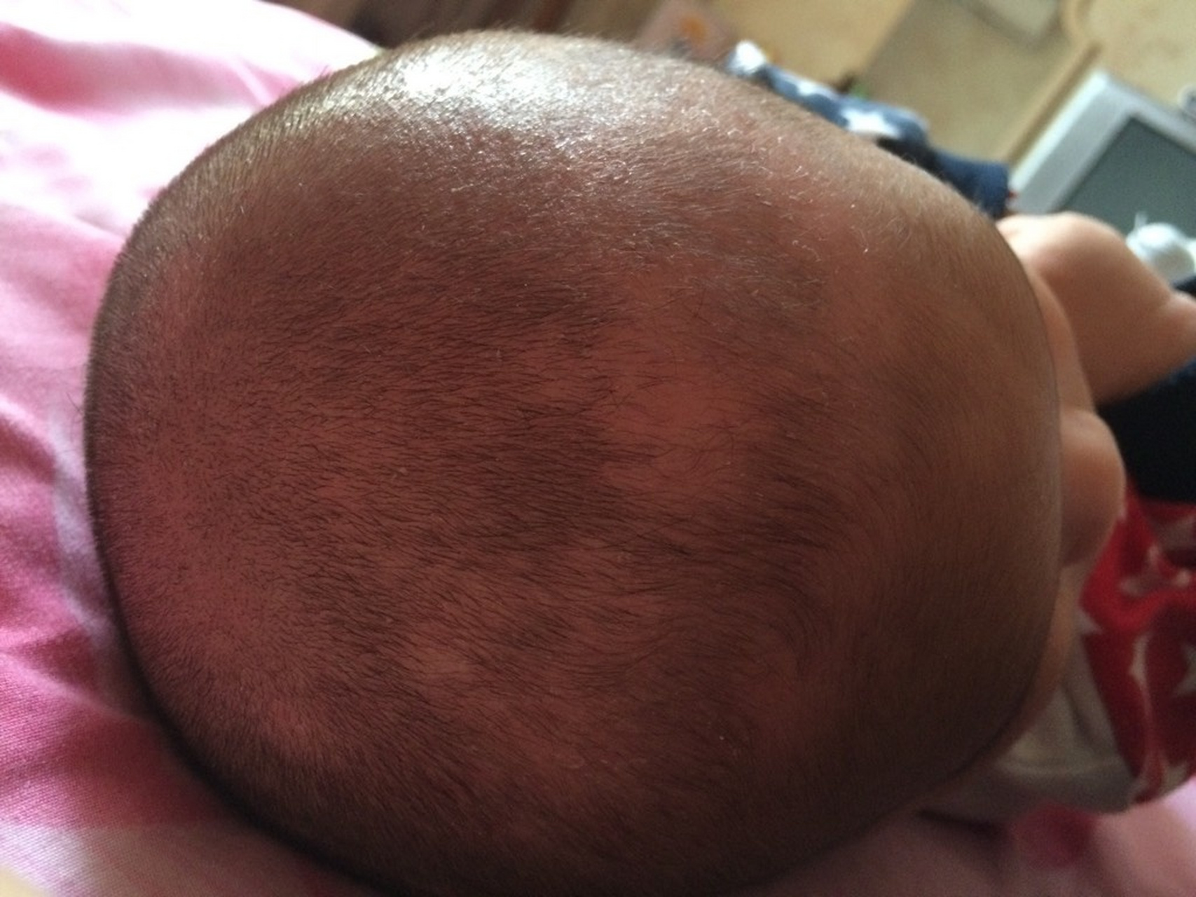 三个月的宝宝掉头发,比较常见的原因主要有以下几方面: 96 1