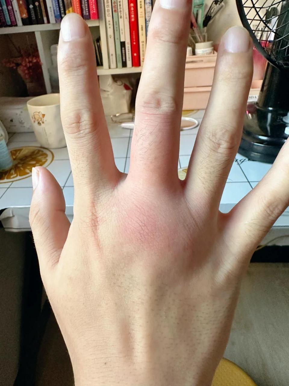 这个成都蚊子太毒了,一觉起来给咬成这样,痛的没办法,有人知道啥原因