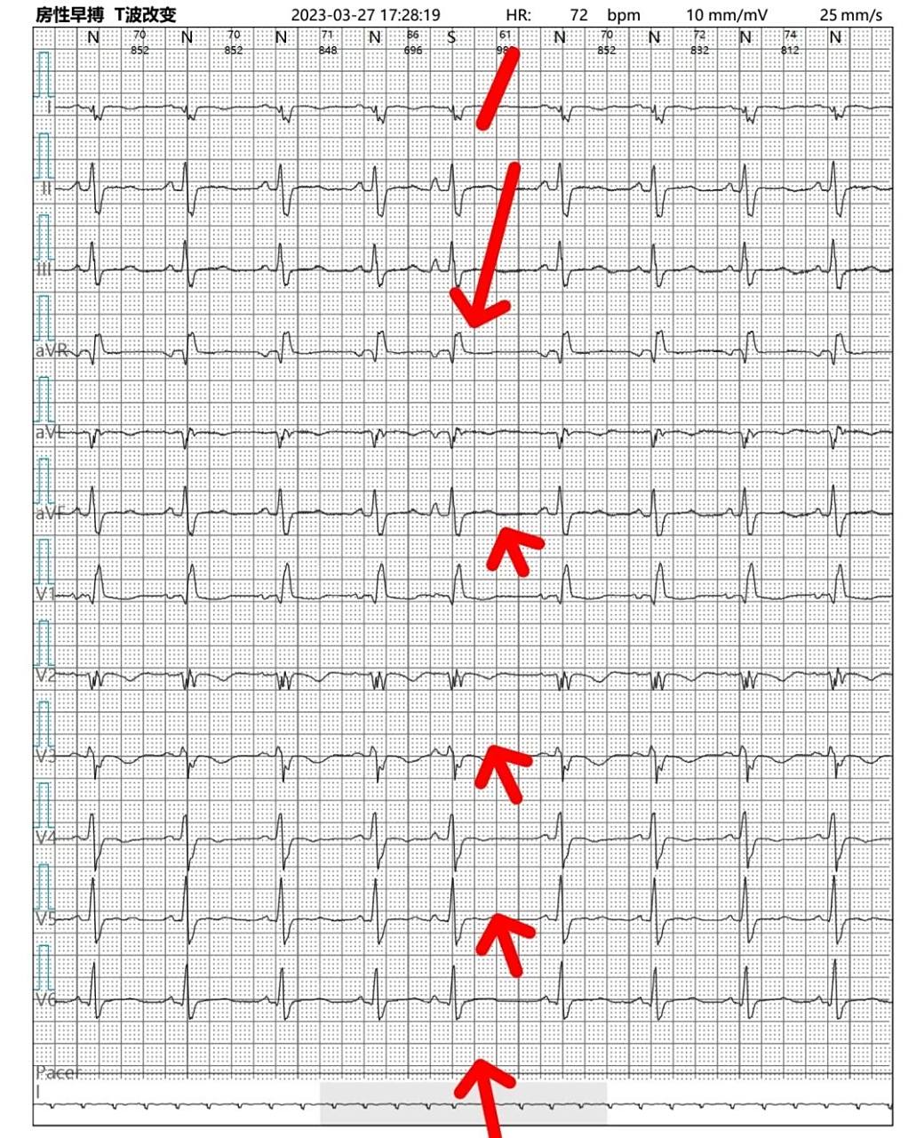 一起学习心电图(室早房早之简单入门) 最近神内接触的都是脑梗患者