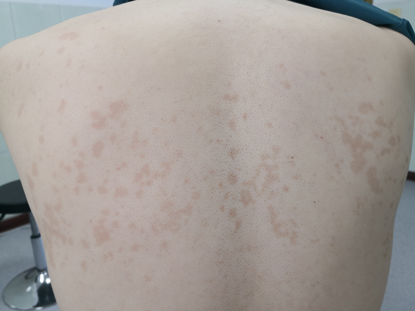 躯干部位多发的红斑脱屑症状.考虑花斑癣/汗斑.#真菌##花斑癣