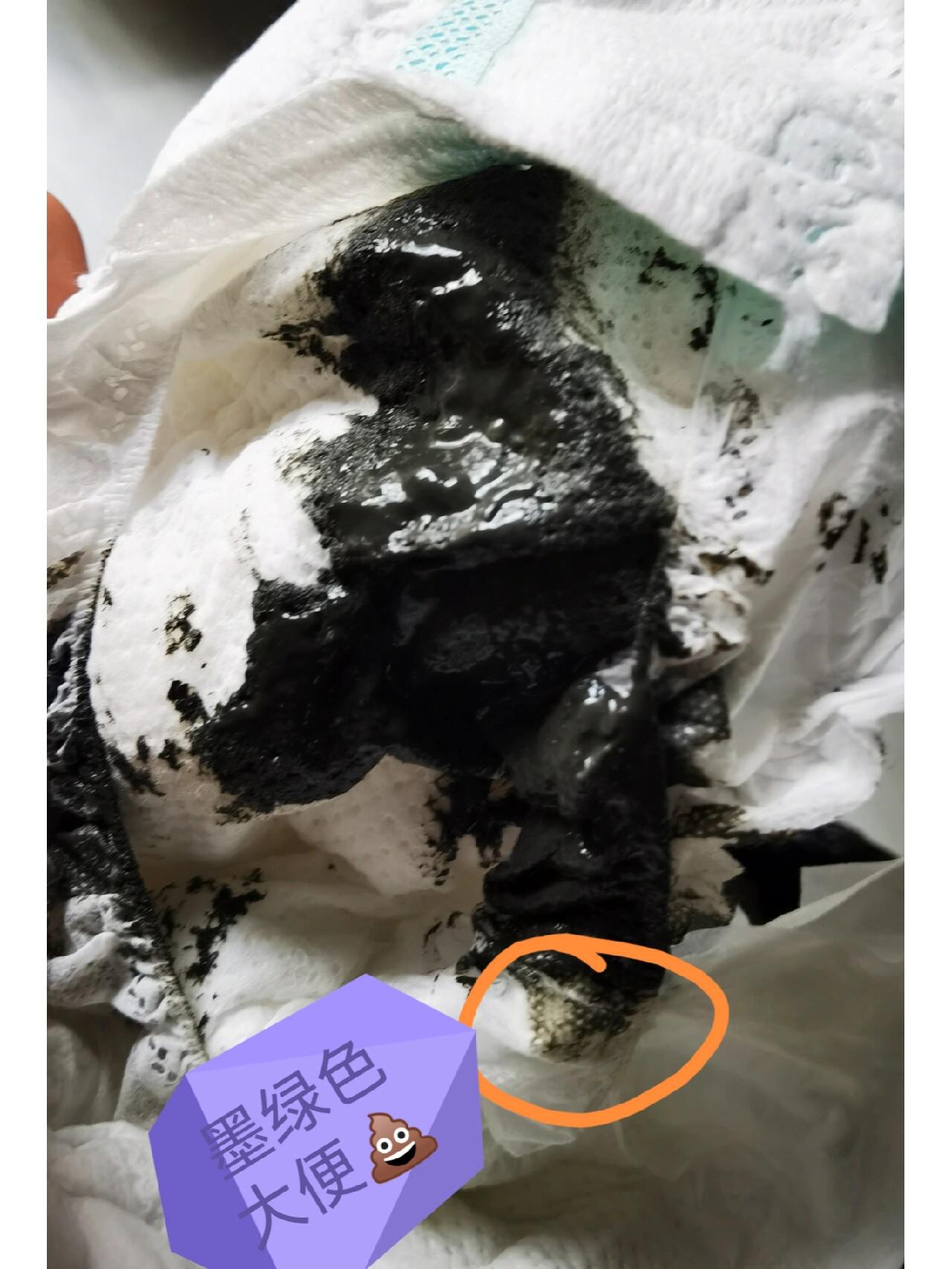 大便是黑色说明在排毒吗为什么在线 大便是黑色说明在排毒吗为什么在线