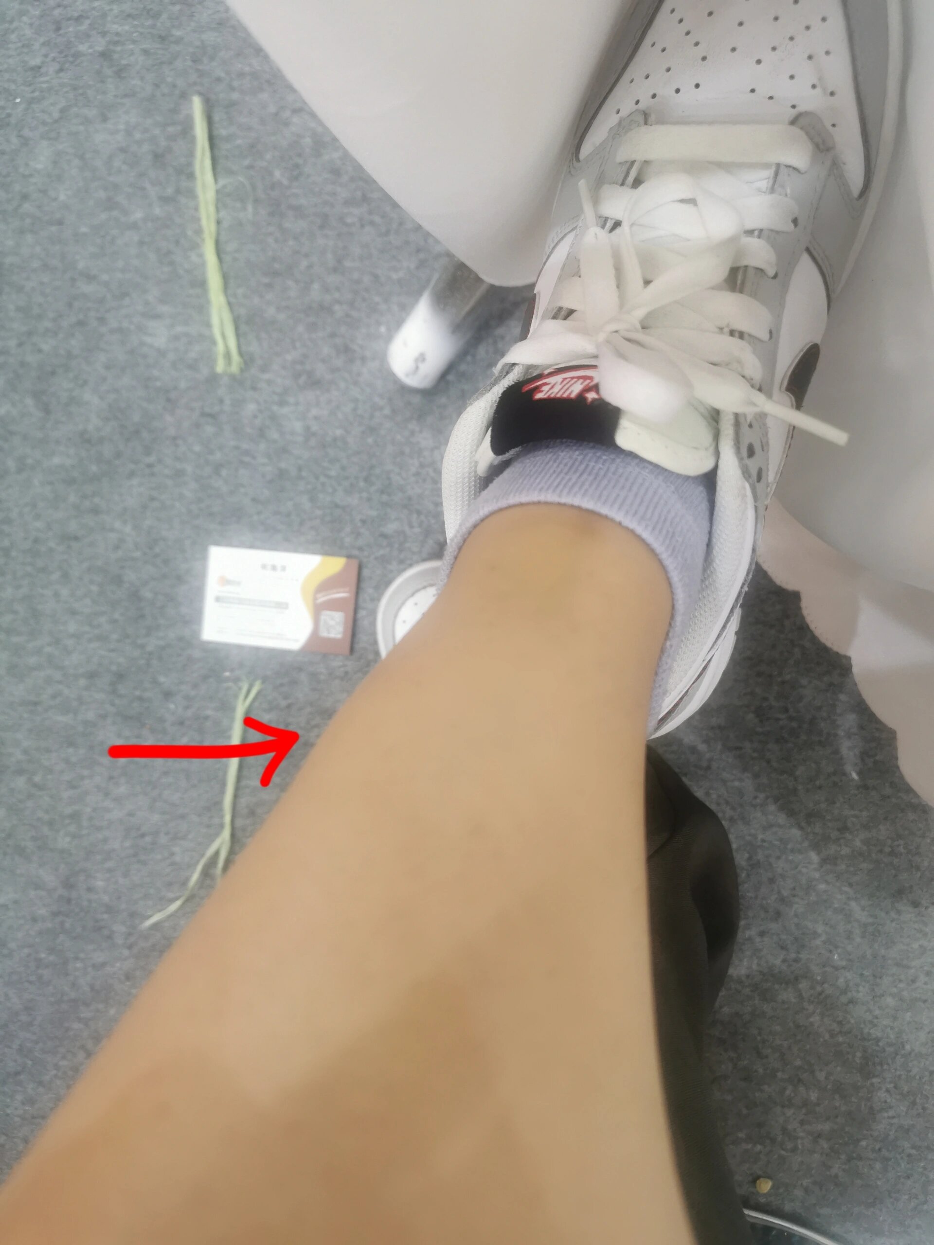 小腿侧边肌肉酸疼鼓包怎么回事啊!