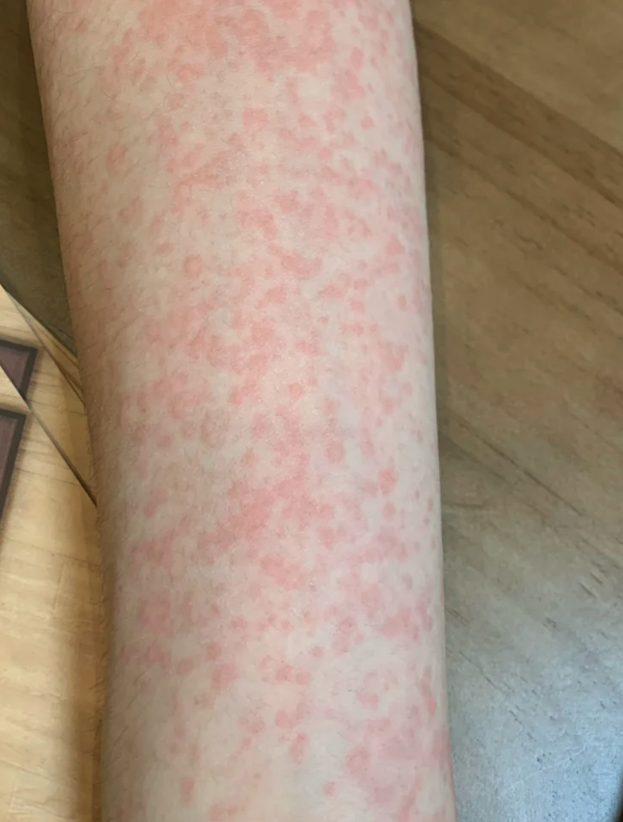 出汗后胳膊出现红斑,常见原因包括过敏性皮炎,日光性皮炎和荨麻疹