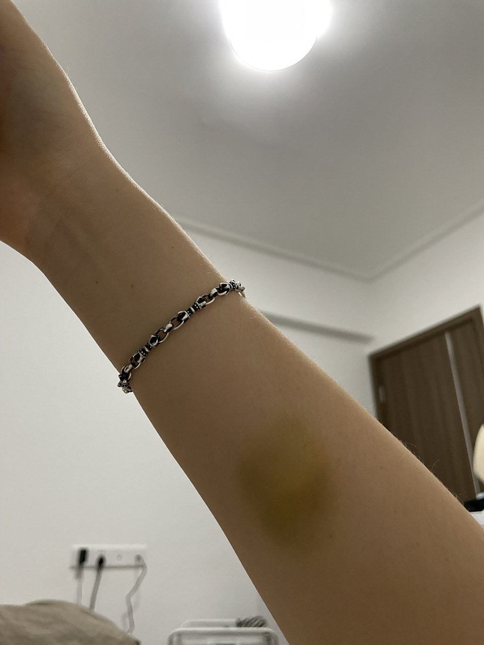 胳膊青了很久了… 有人知道这是怎么回事吗,就是不小心碰到就会青,青