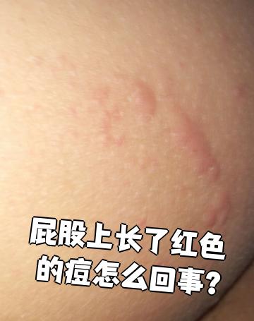 屁股上长红痘最常见的原因是湿疹或毛囊炎,这两种情况需要不同的