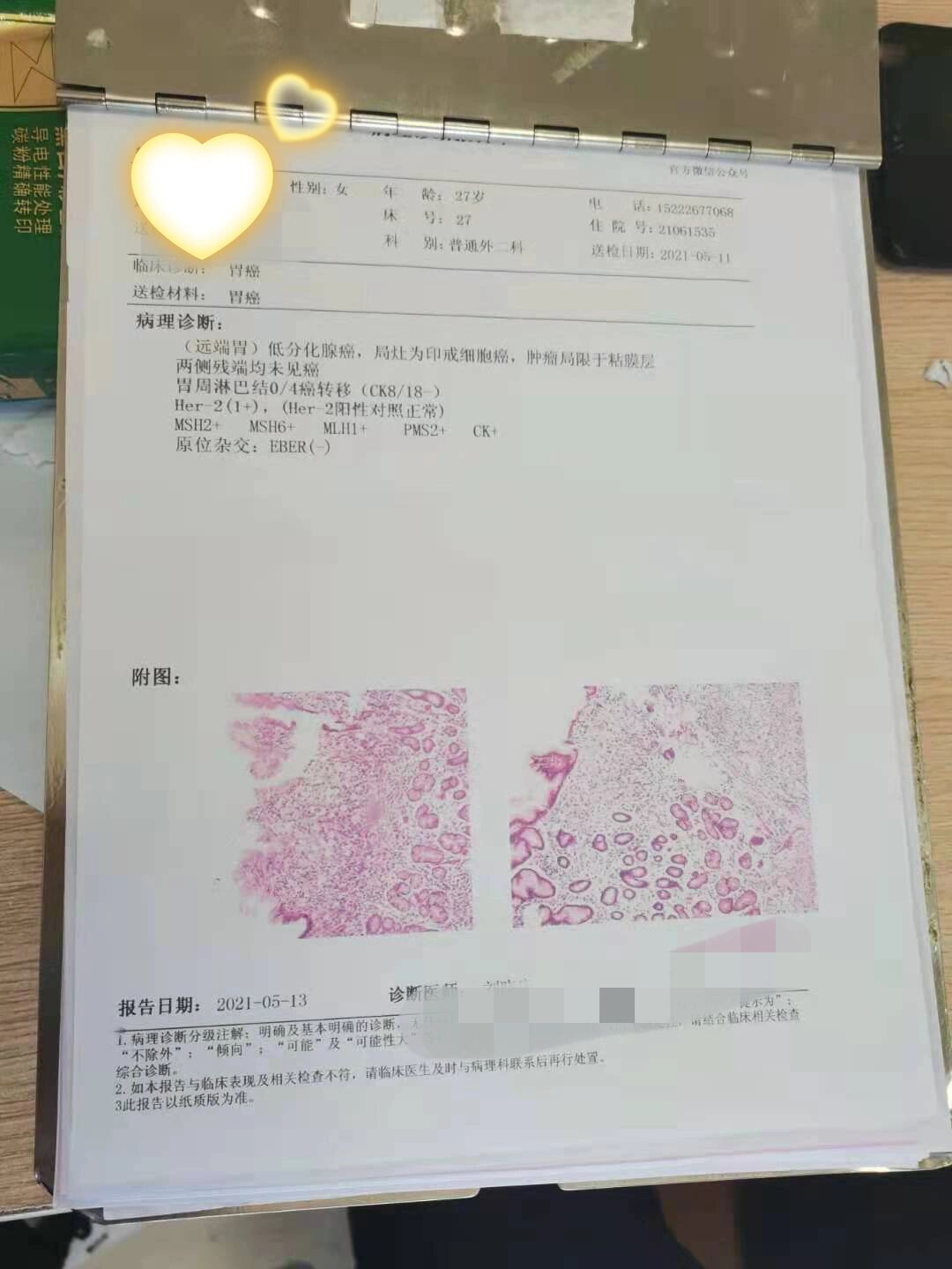有没有早期胃癌没化疗的小伙伴