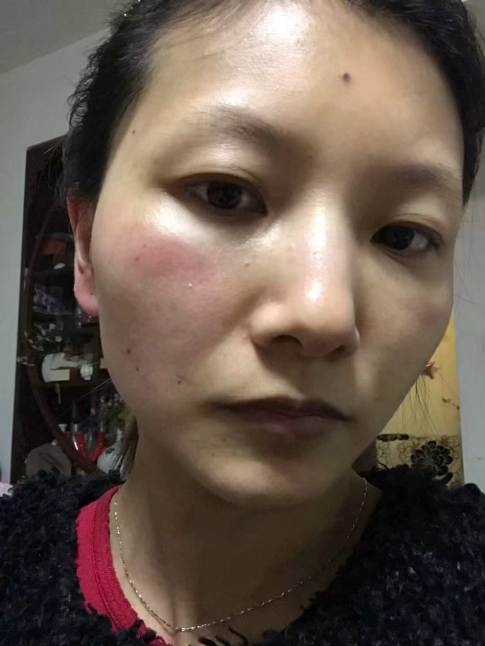 玫瑰痤疮,最严重的爆发期 图一为第一次正规治疗前,2018年七月.