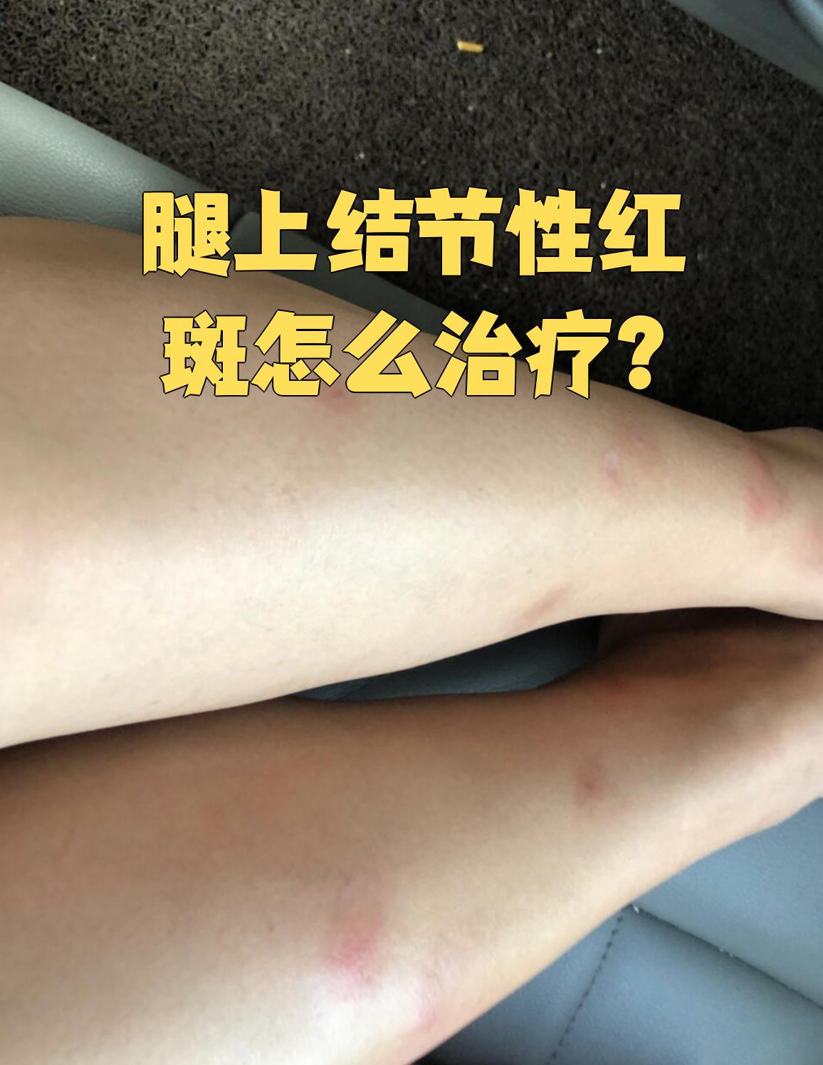 腿上结节性红斑的治疗方法主要根据具体症状来决定
