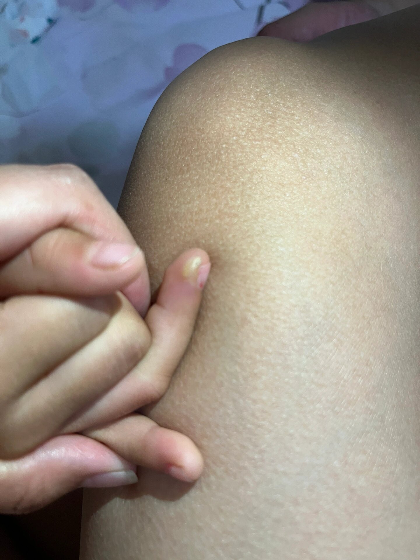 儿童甲周疣 女儿两只手的无名指指甲旁边突然出现了类似茧子的东西